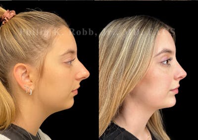 Ultrasonic Rhinoplasty Before & After Gallery - Patient 146930 - Image 1