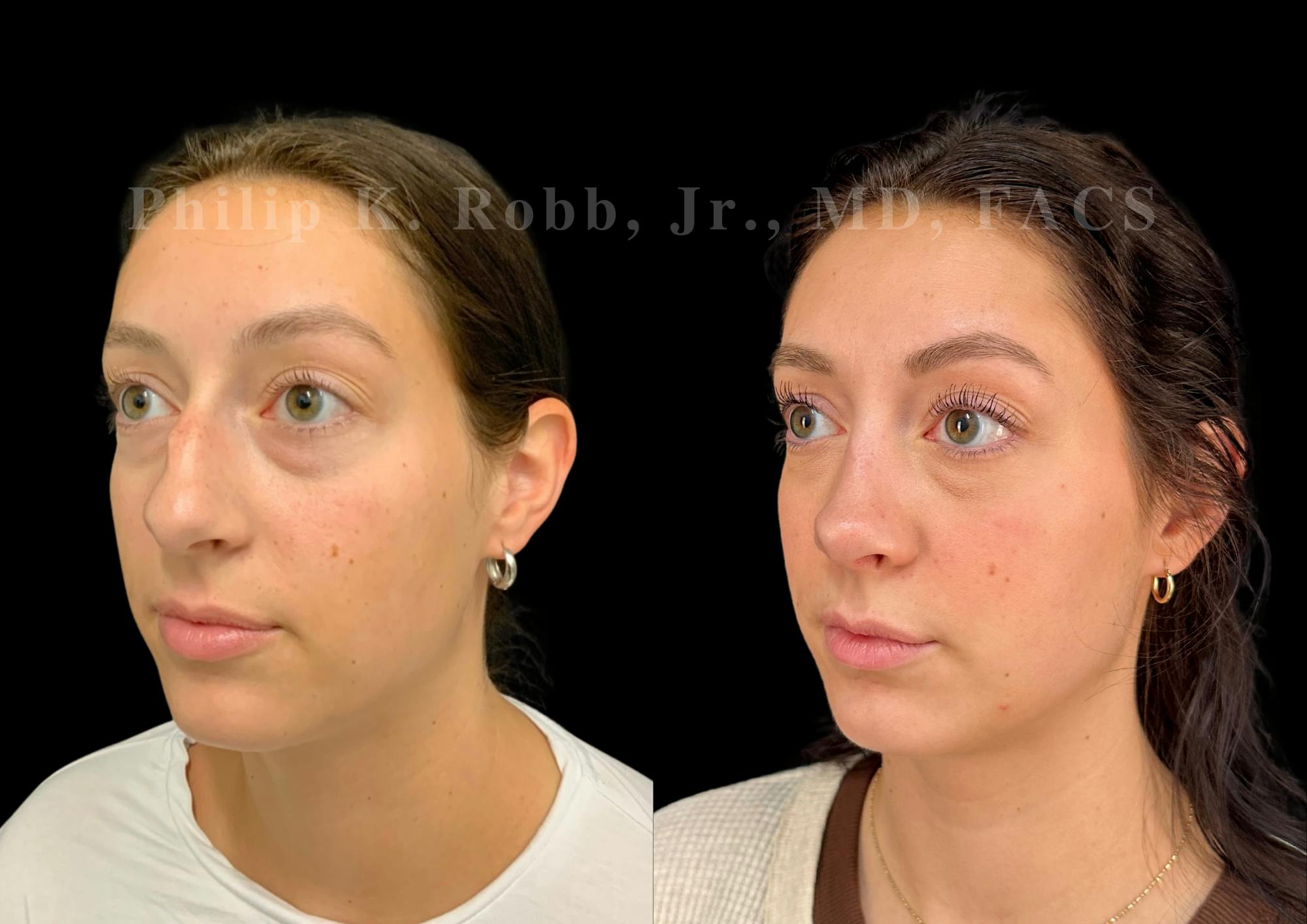 Ultrasonic Rhinoplasty Before & After Gallery - Patient 109174 - Image 4