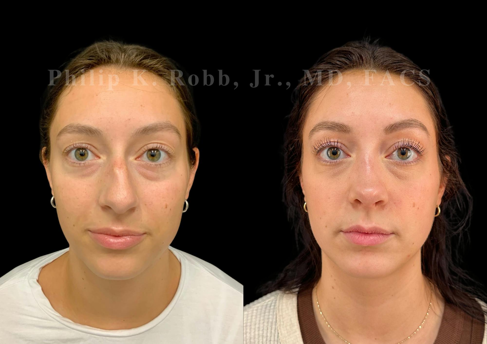 Ultrasonic Rhinoplasty Before & After Gallery - Patient 109174 - Image 3