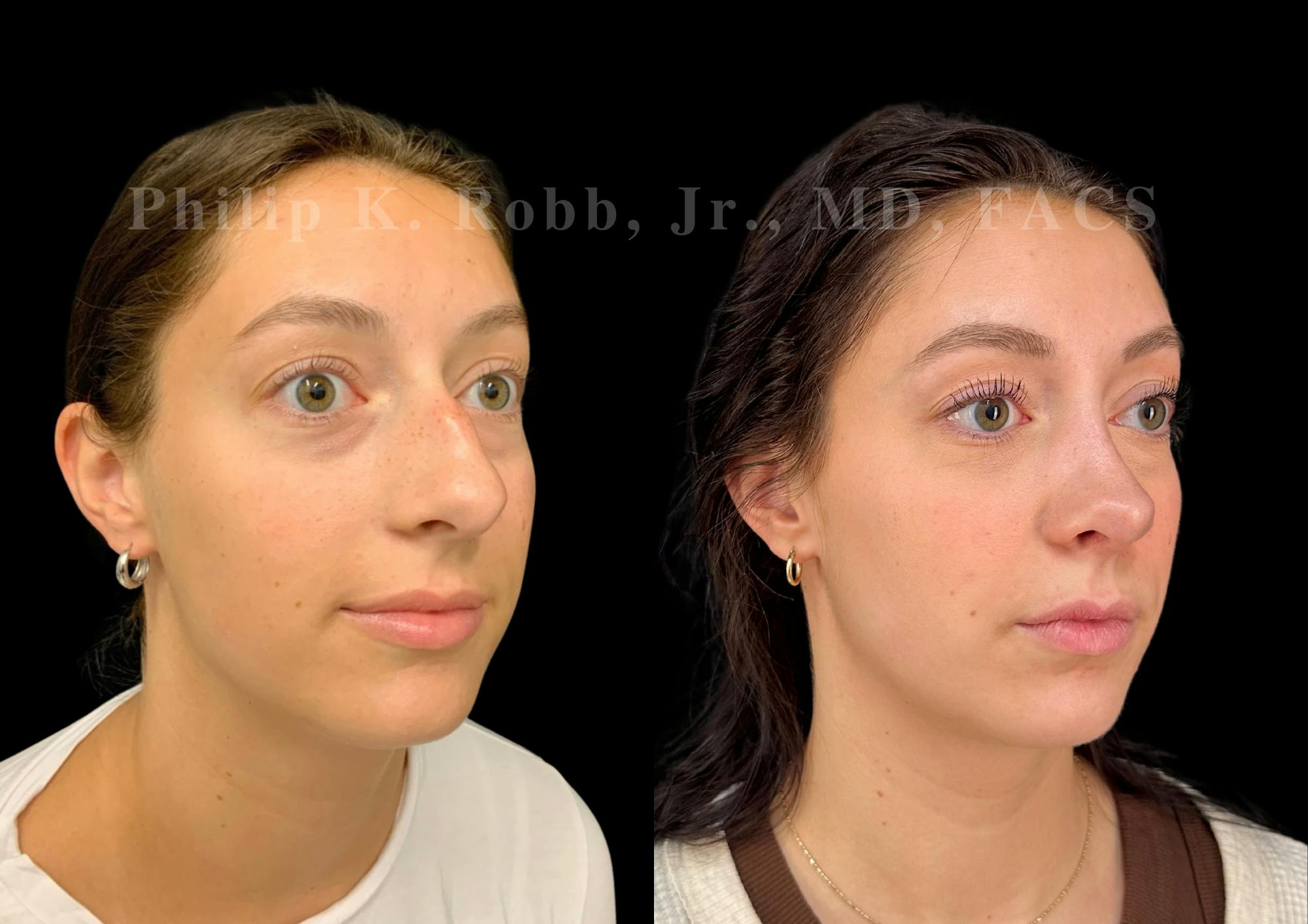 Ultrasonic Rhinoplasty Before & After Gallery - Patient 109174 - Image 2