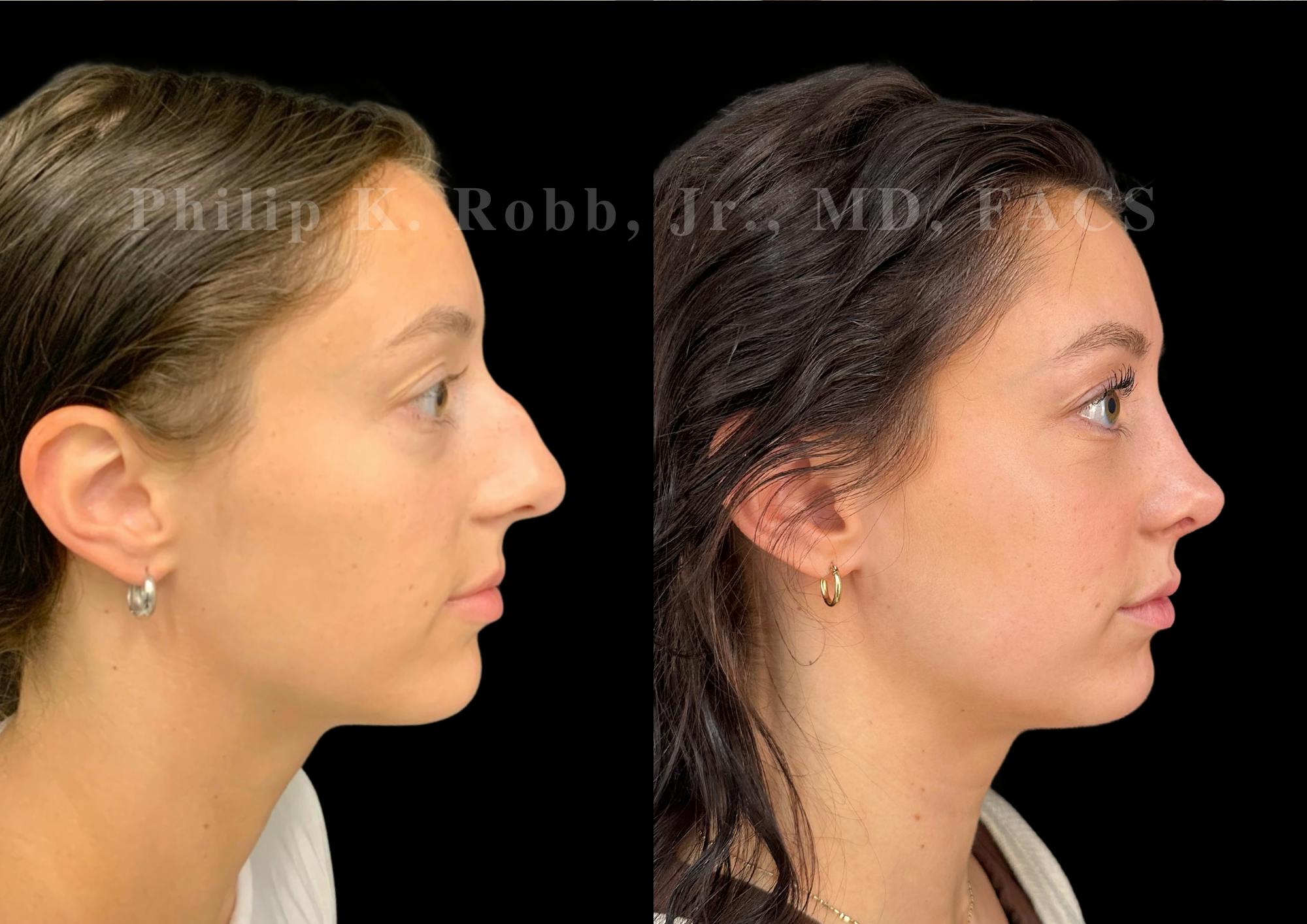 Ultrasonic Rhinoplasty Before & After Gallery - Patient 109174 - Image 1
