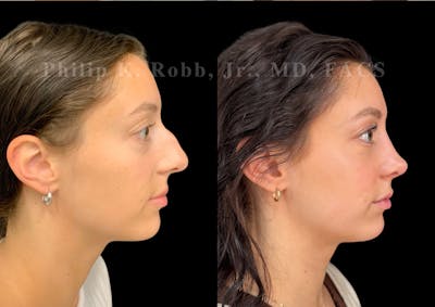 Ultrasonic Rhinoplasty Before & After Gallery - Patient 109174 - Image 1