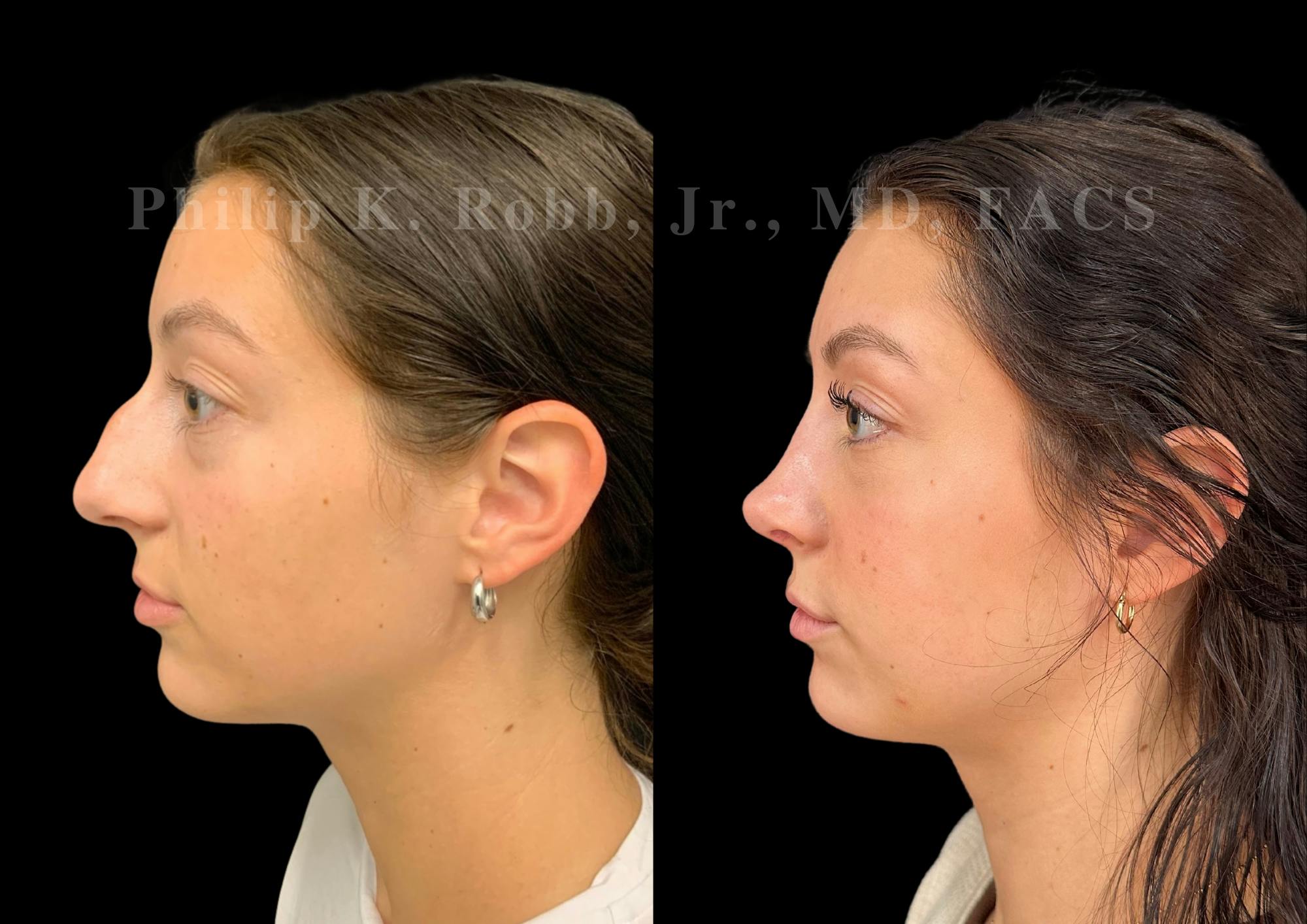 Ultrasonic Rhinoplasty Before & After Gallery - Patient 109174 - Image 5