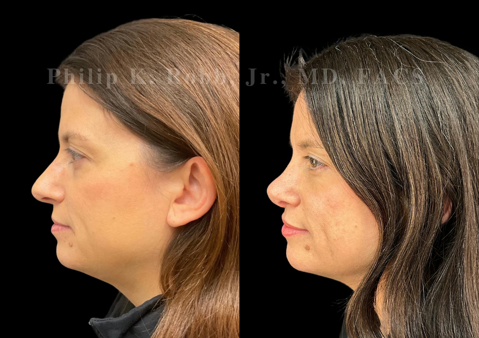 Ultrasonic Rhinoplasty Before & After Gallery - Patient 996974 - Image 5