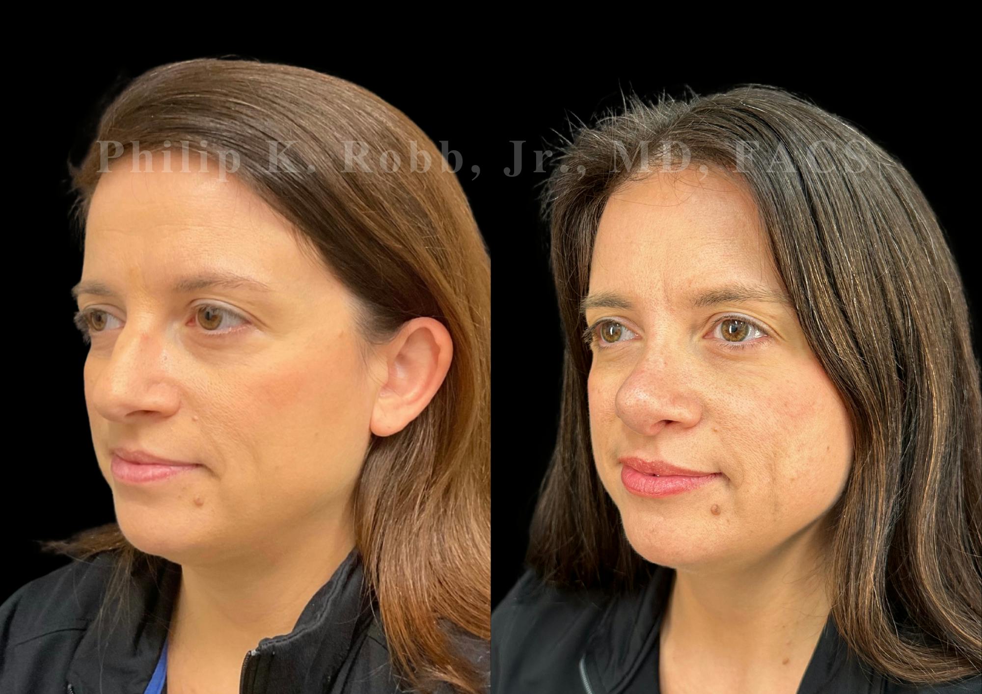 Ultrasonic Rhinoplasty Before & After Gallery - Patient 996974 - Image 4