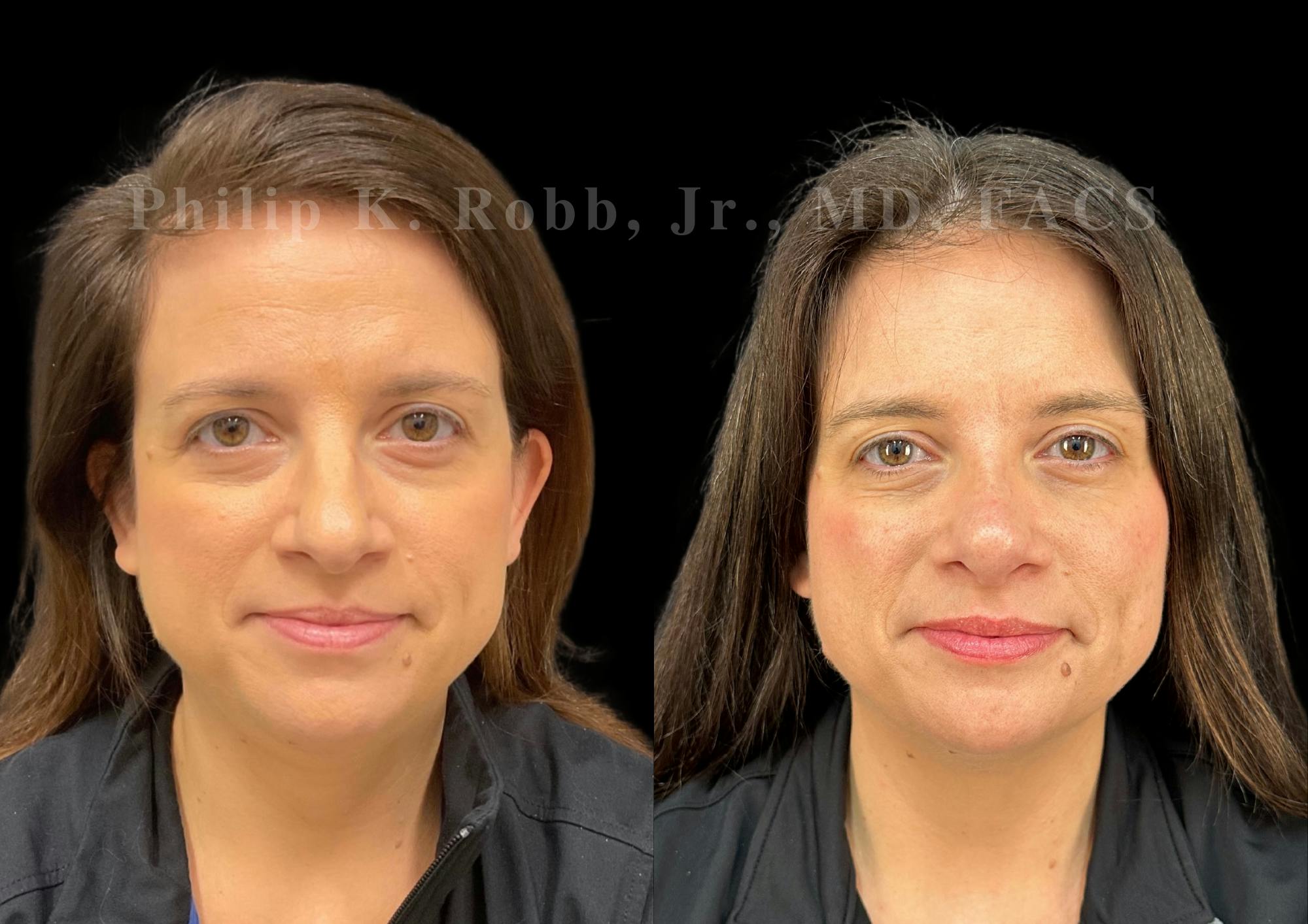 Ultrasonic Rhinoplasty Before & After Gallery - Patient 996974 - Image 3
