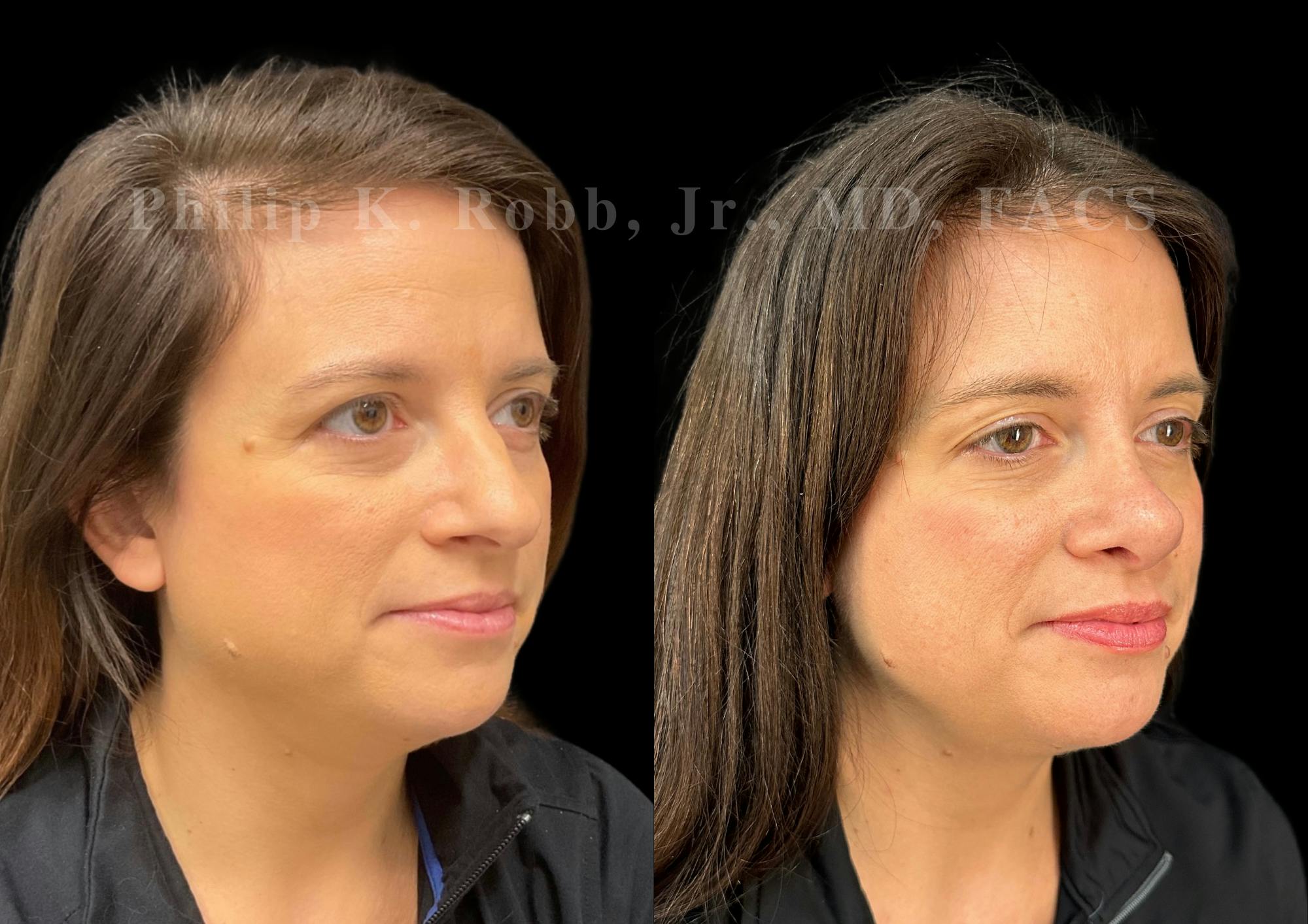 Ultrasonic Rhinoplasty Before & After Gallery - Patient 996974 - Image 2