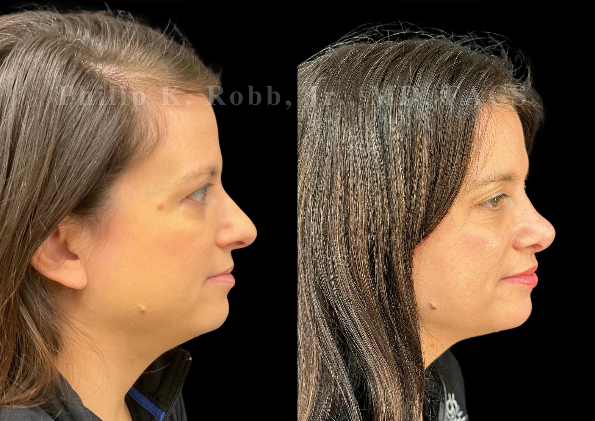 Ultrasonic Rhinoplasty Before & After Gallery - Patient 996974 - Image 1