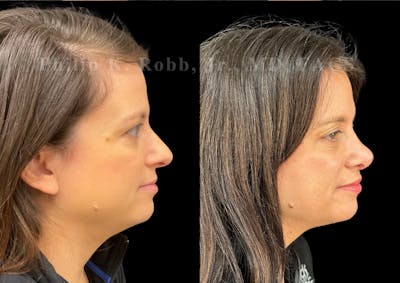 Ultrasonic Rhinoplasty Before & After Gallery - Patient 996974 - Image 1