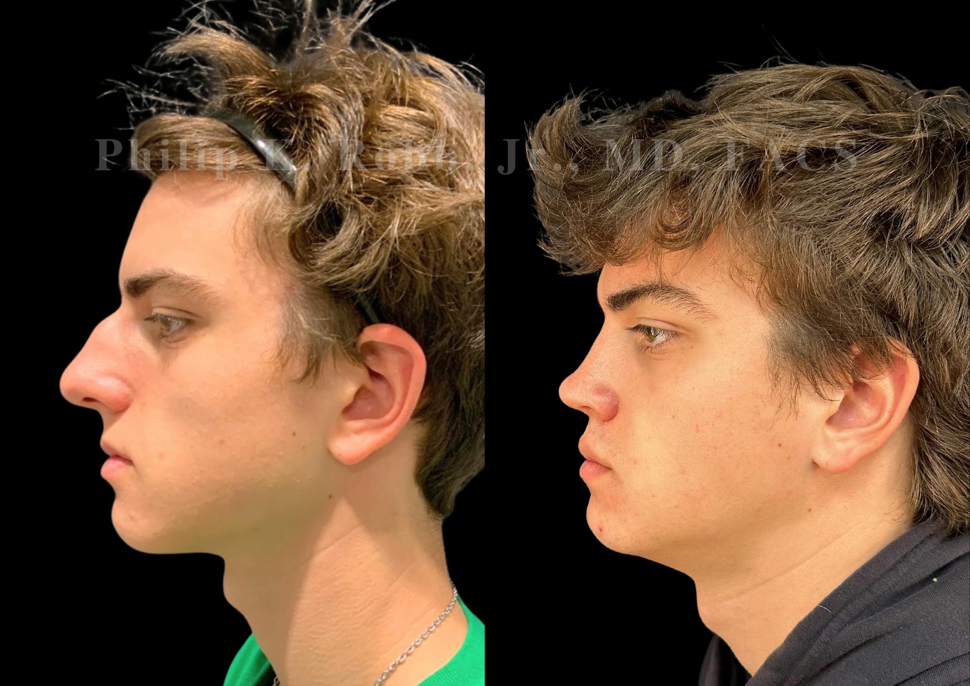 Ultrasonic Rhinoplasty Before & After Gallery - Patient 349194 - Image 5