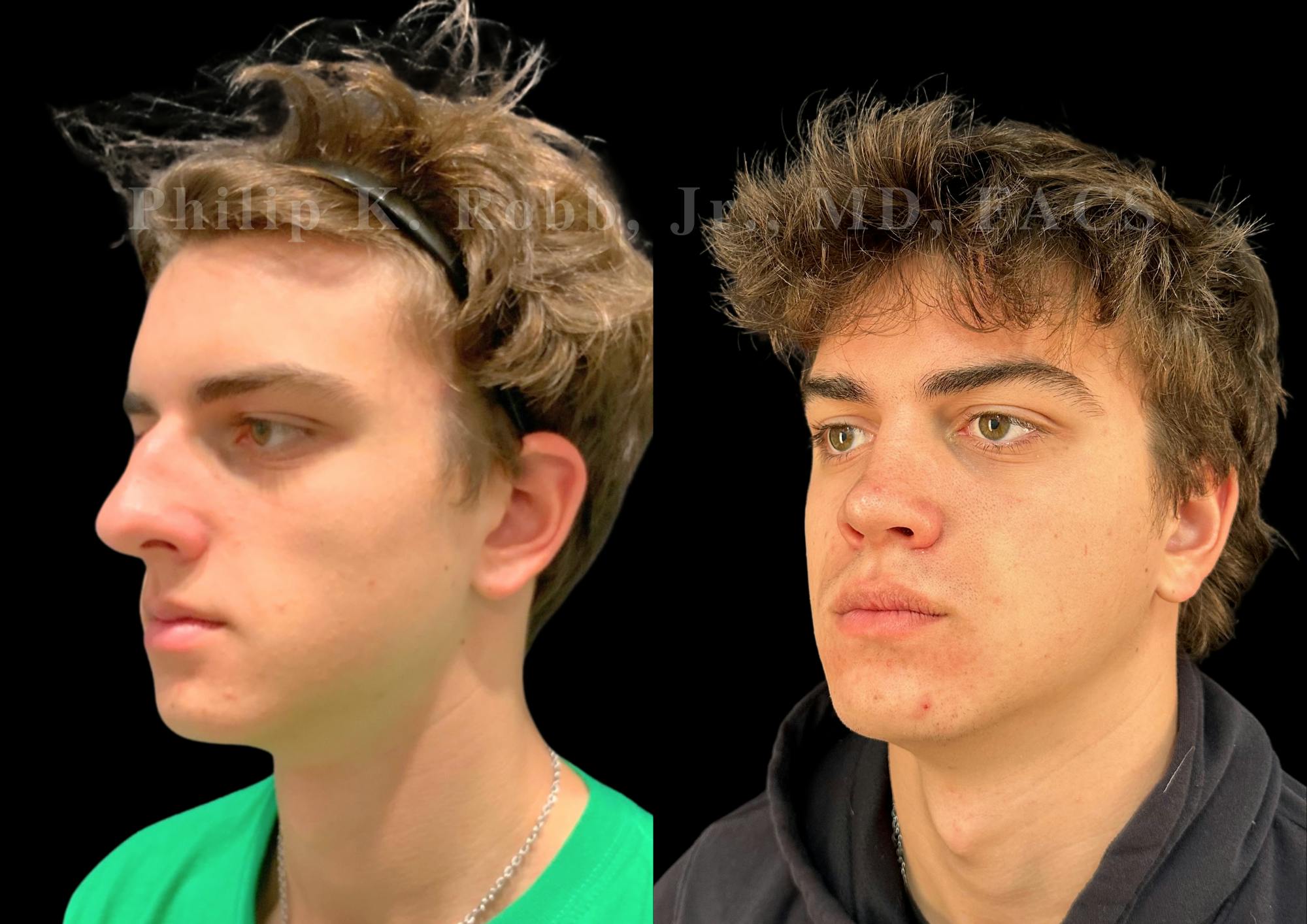 Ultrasonic Rhinoplasty Before & After Gallery - Patient 349194 - Image 4