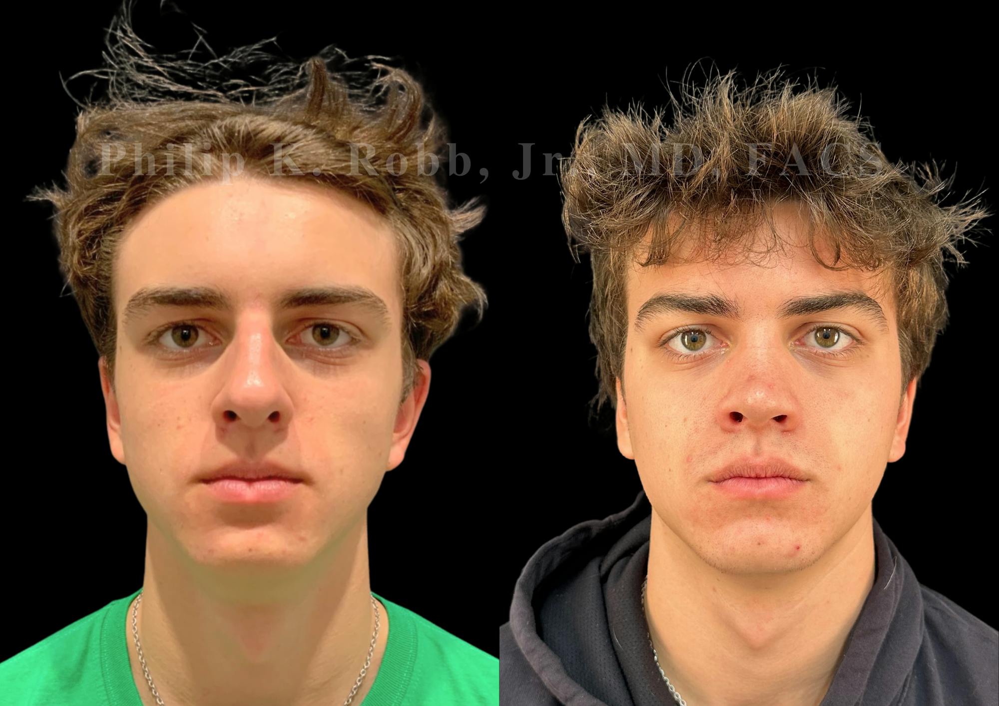 Ultrasonic Rhinoplasty Before & After Gallery - Patient 349194 - Image 3