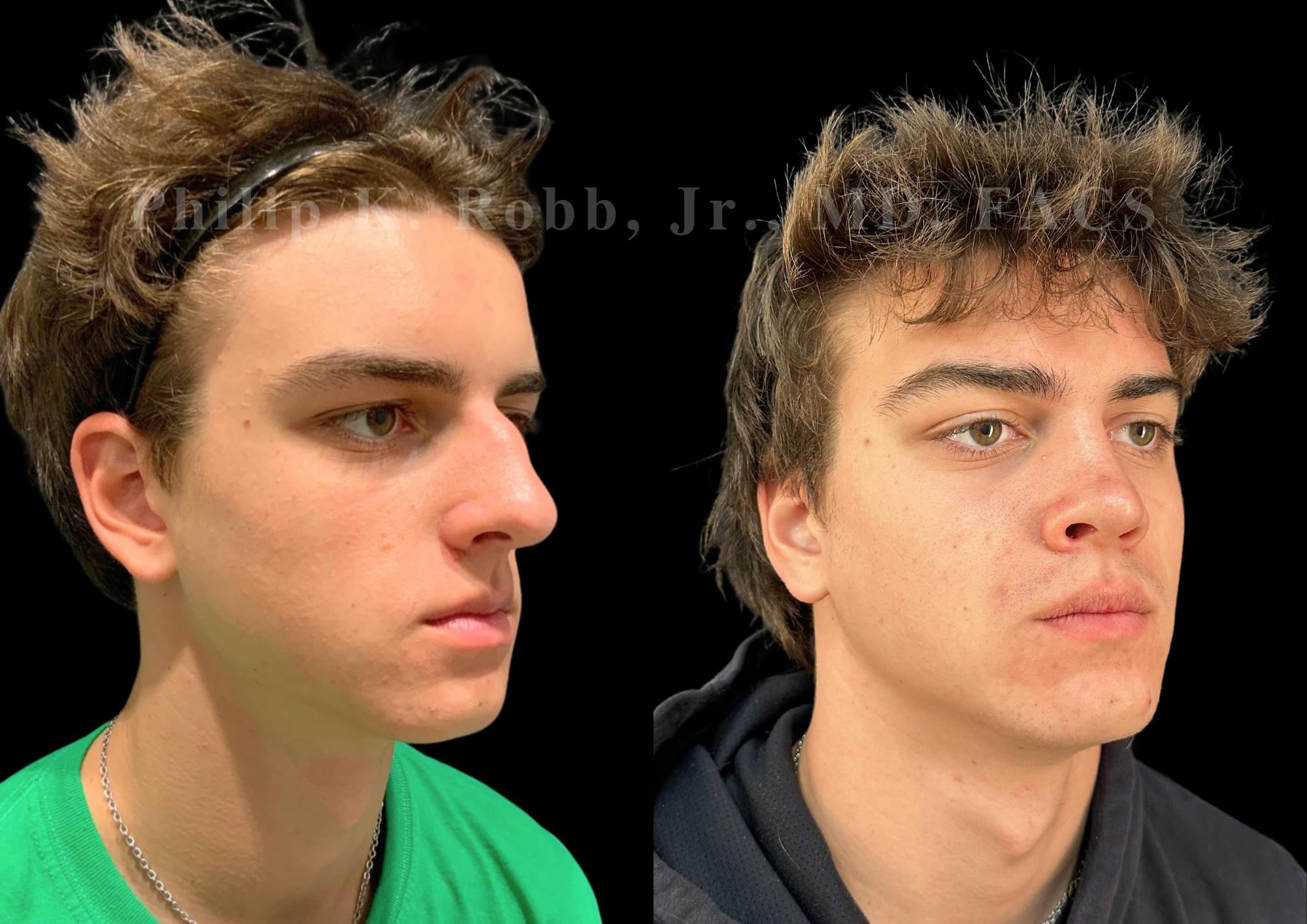Ultrasonic Rhinoplasty Before & After Gallery - Patient 349194 - Image 2
