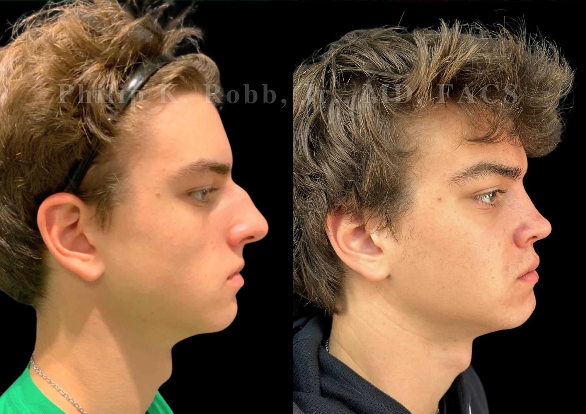 Ultrasonic Rhinoplasty Before & After Gallery - Patient 349194 - Image 1