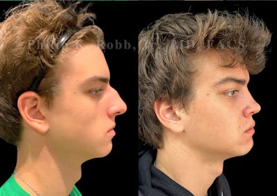 Ultrasonic Rhinoplasty Before & After Gallery - Patient 349194 - Image 1