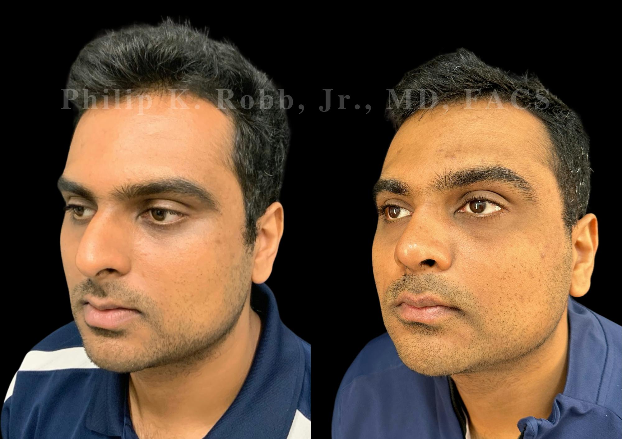 Ultrasonic Rhinoplasty Before & After Gallery - Patient 227200 - Image 4