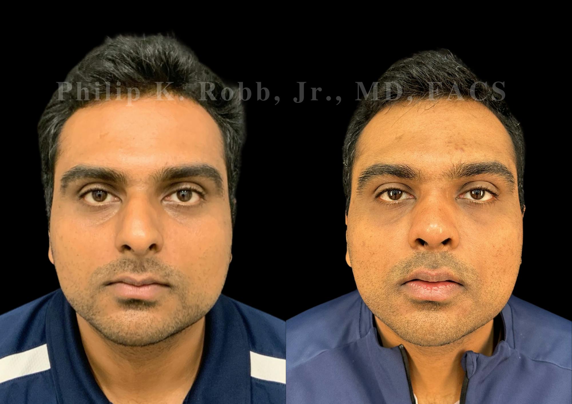 Ultrasonic Rhinoplasty Before & After Gallery - Patient 227200 - Image 3