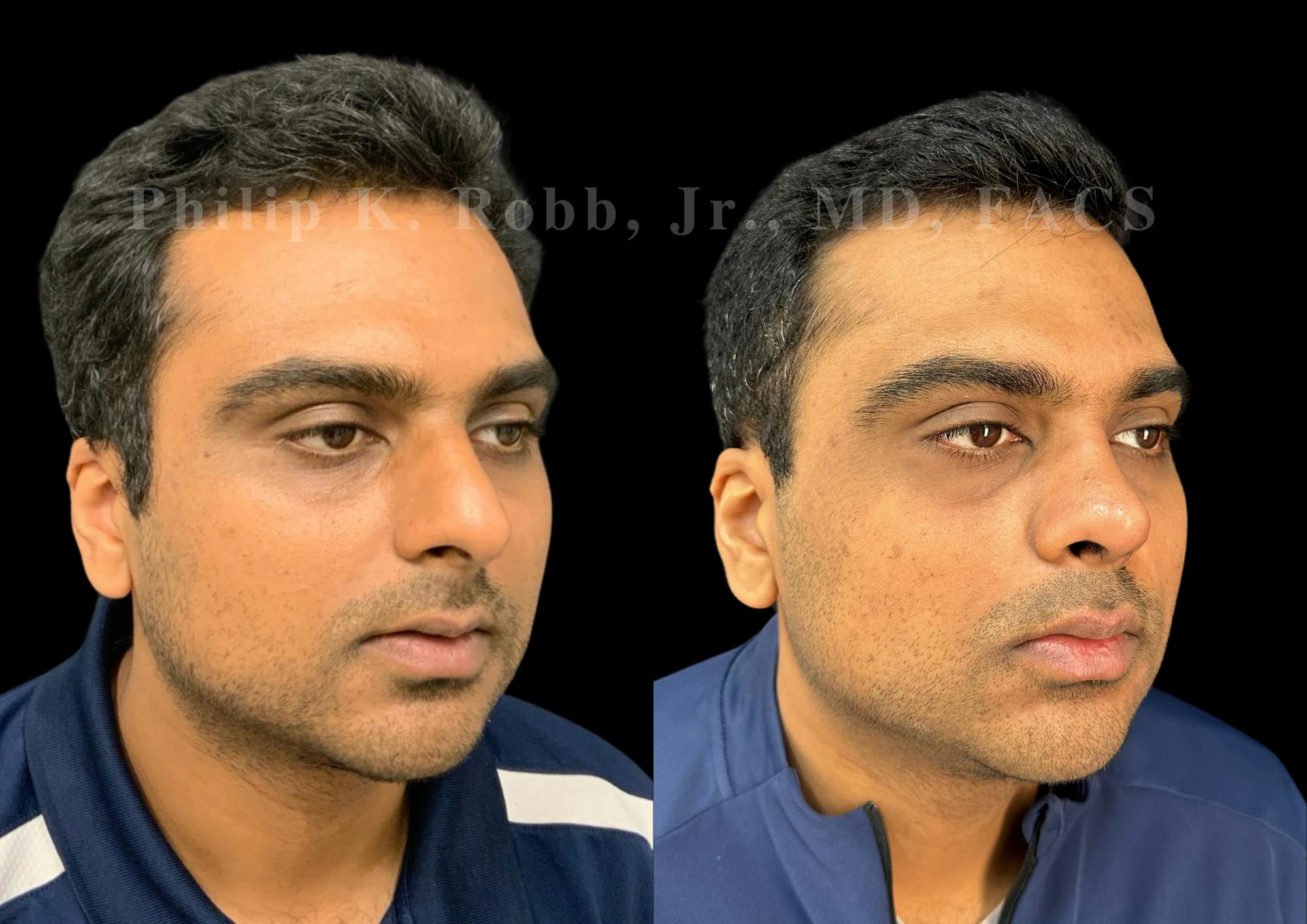 Ultrasonic Rhinoplasty Before & After Gallery - Patient 227200 - Image 2
