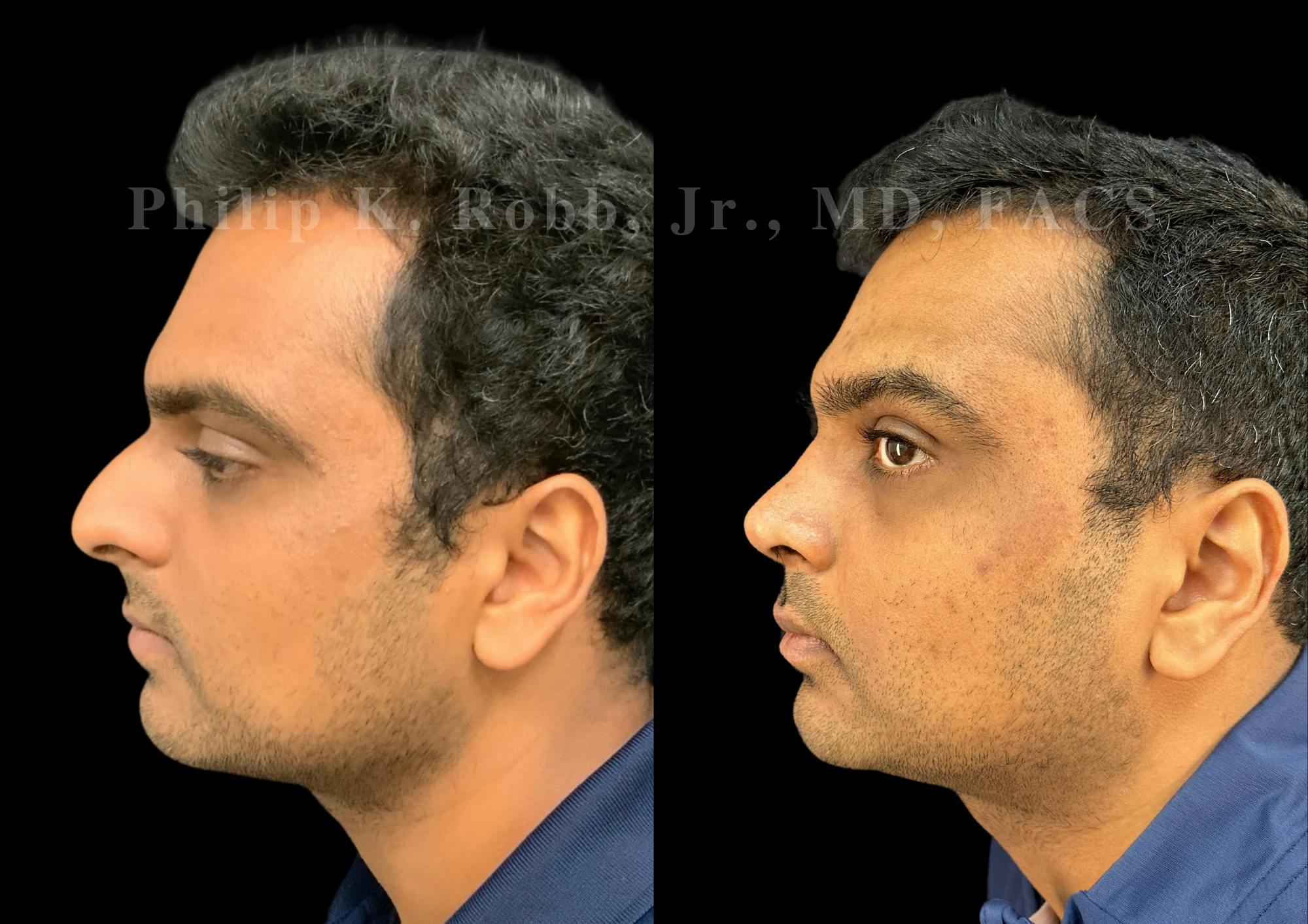 Ultrasonic Rhinoplasty Before & After Gallery - Patient 227200 - Image 5