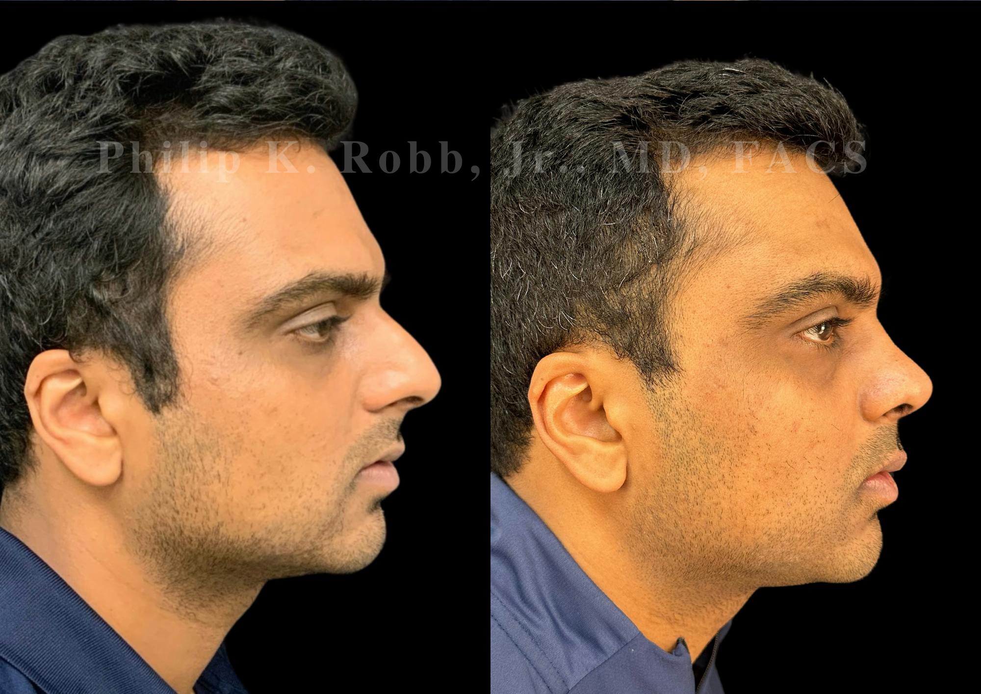 Ultrasonic Rhinoplasty Before & After Gallery - Patient 227200 - Image 1