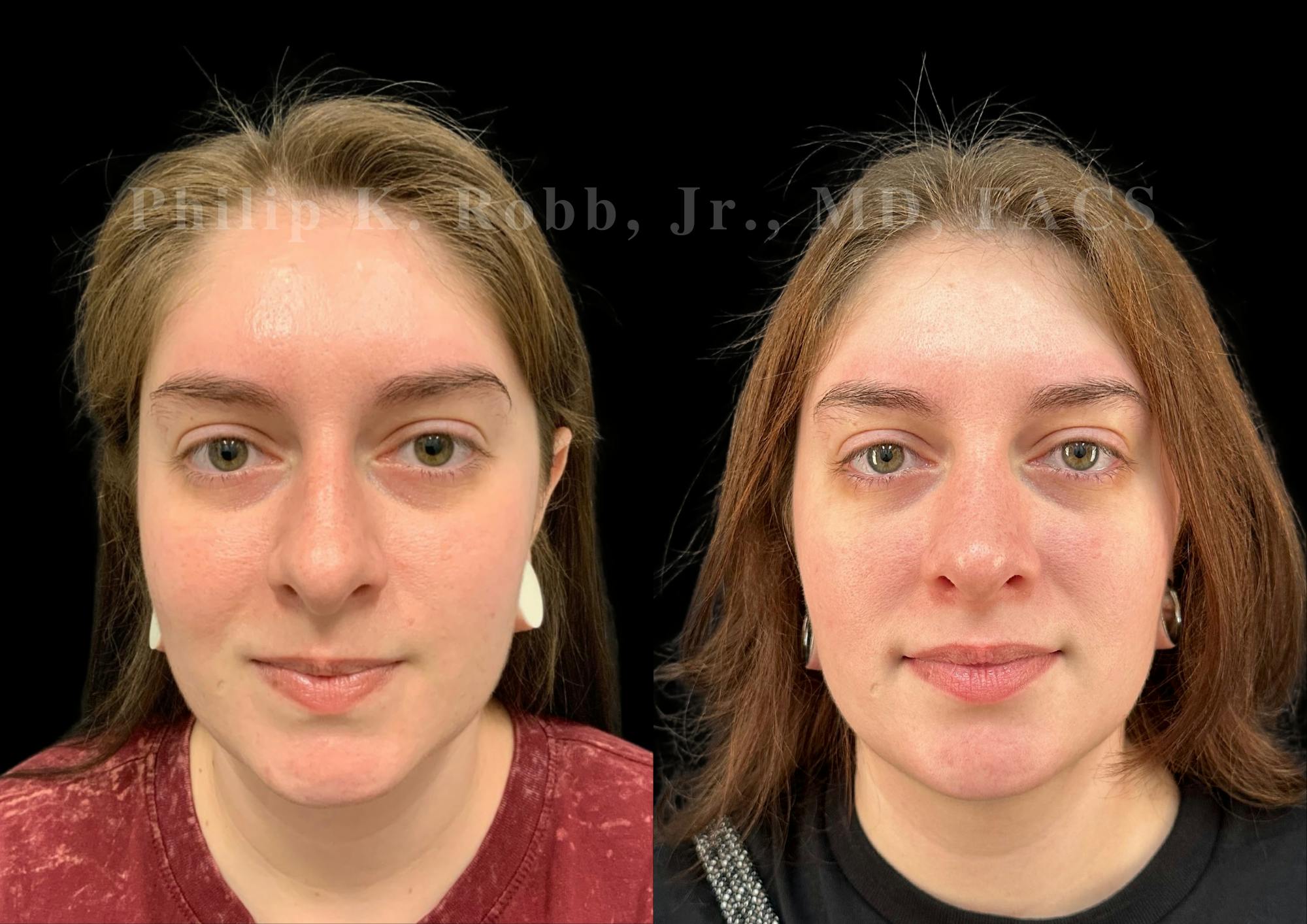 Ultrasonic Rhinoplasty Before & After Gallery - Patient 102521 - Image 3