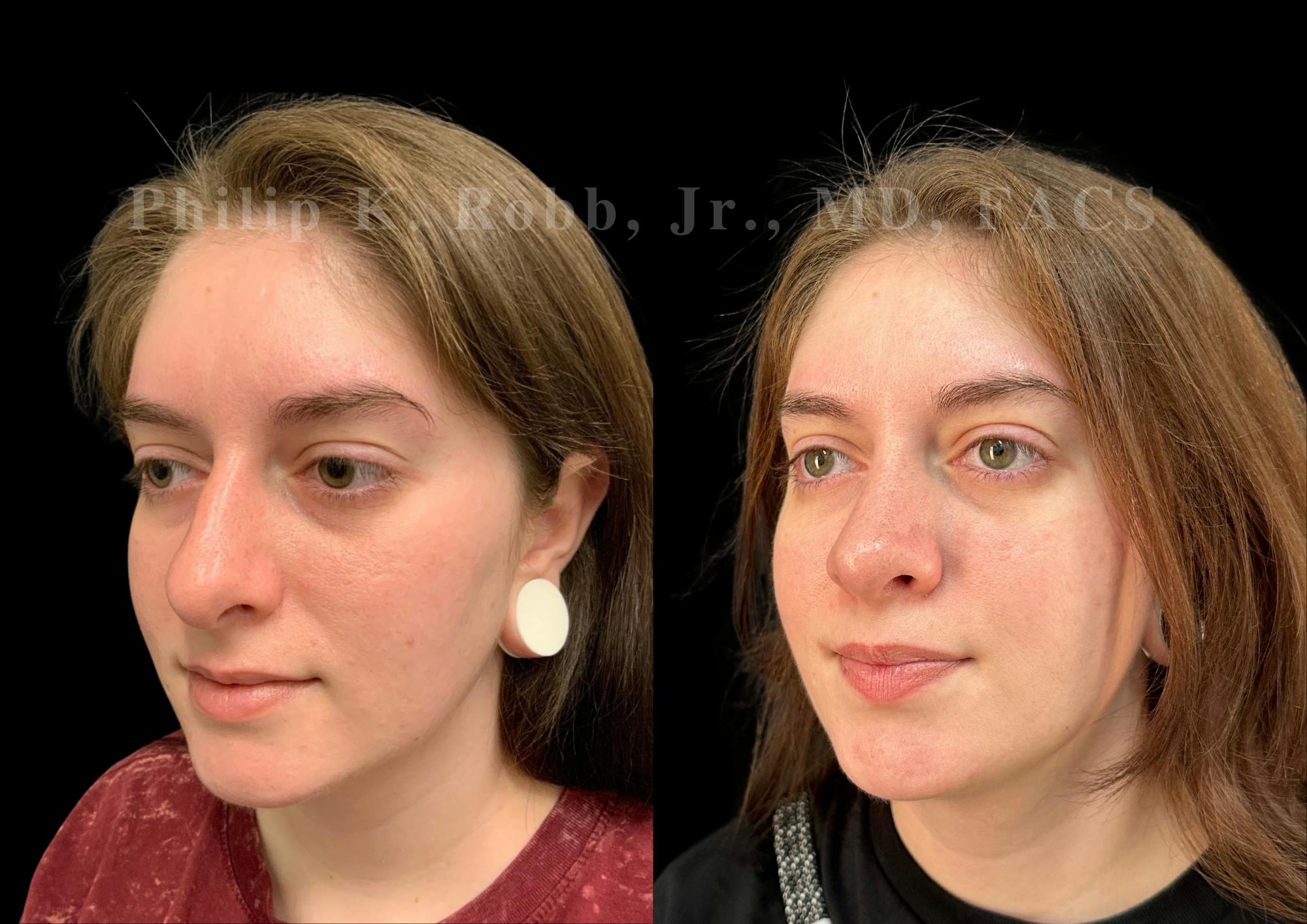Ultrasonic Rhinoplasty Before & After Gallery - Patient 102521 - Image 4