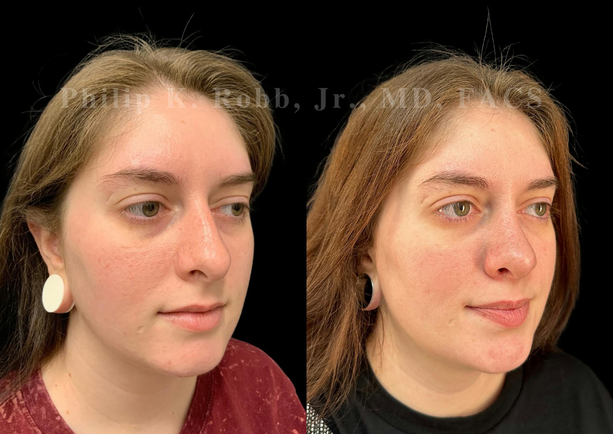 Ultrasonic Rhinoplasty Before & After Gallery - Patient 102521 - Image 2