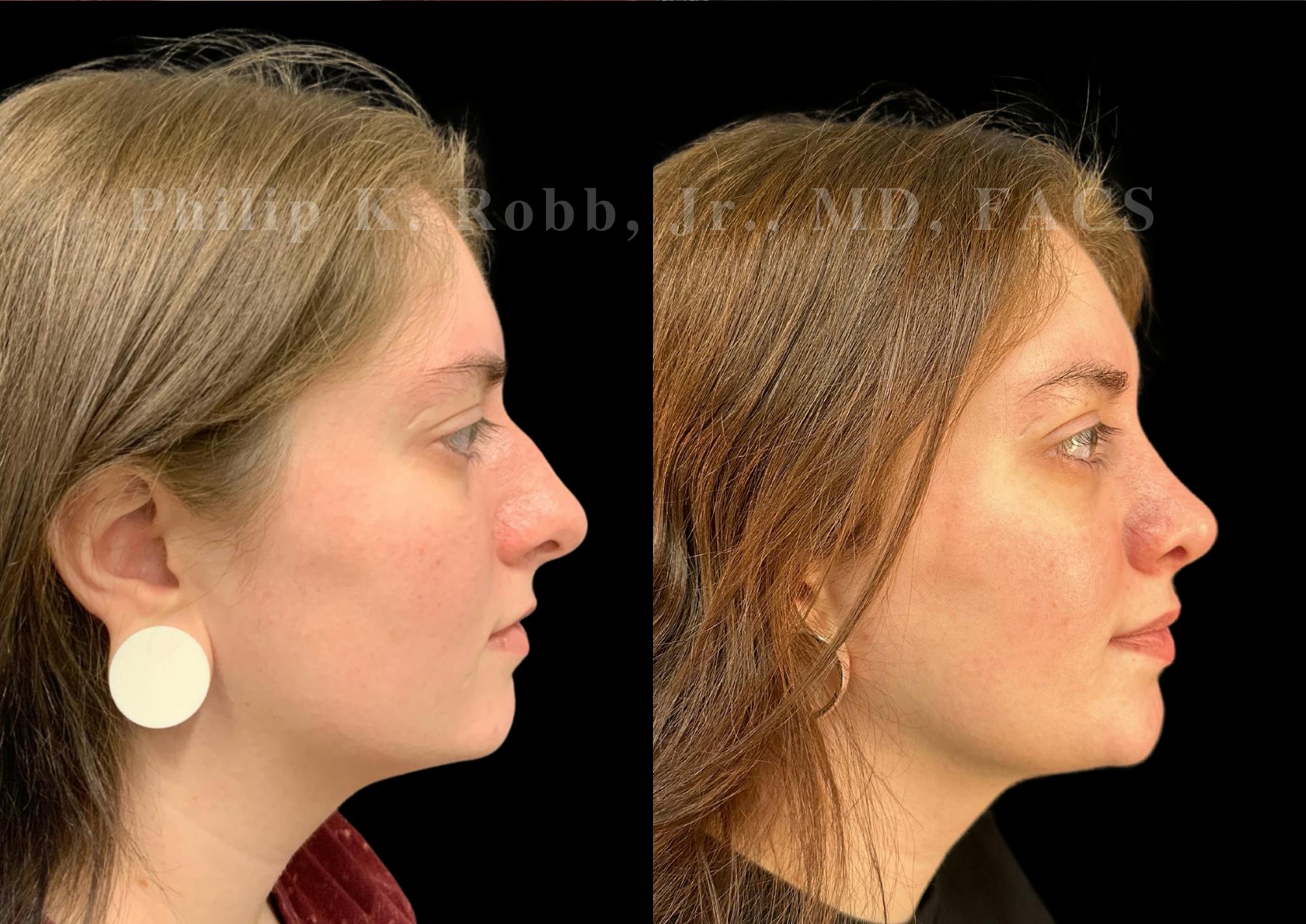 Ultrasonic Rhinoplasty Before & After Gallery - Patient 102521 - Image 1