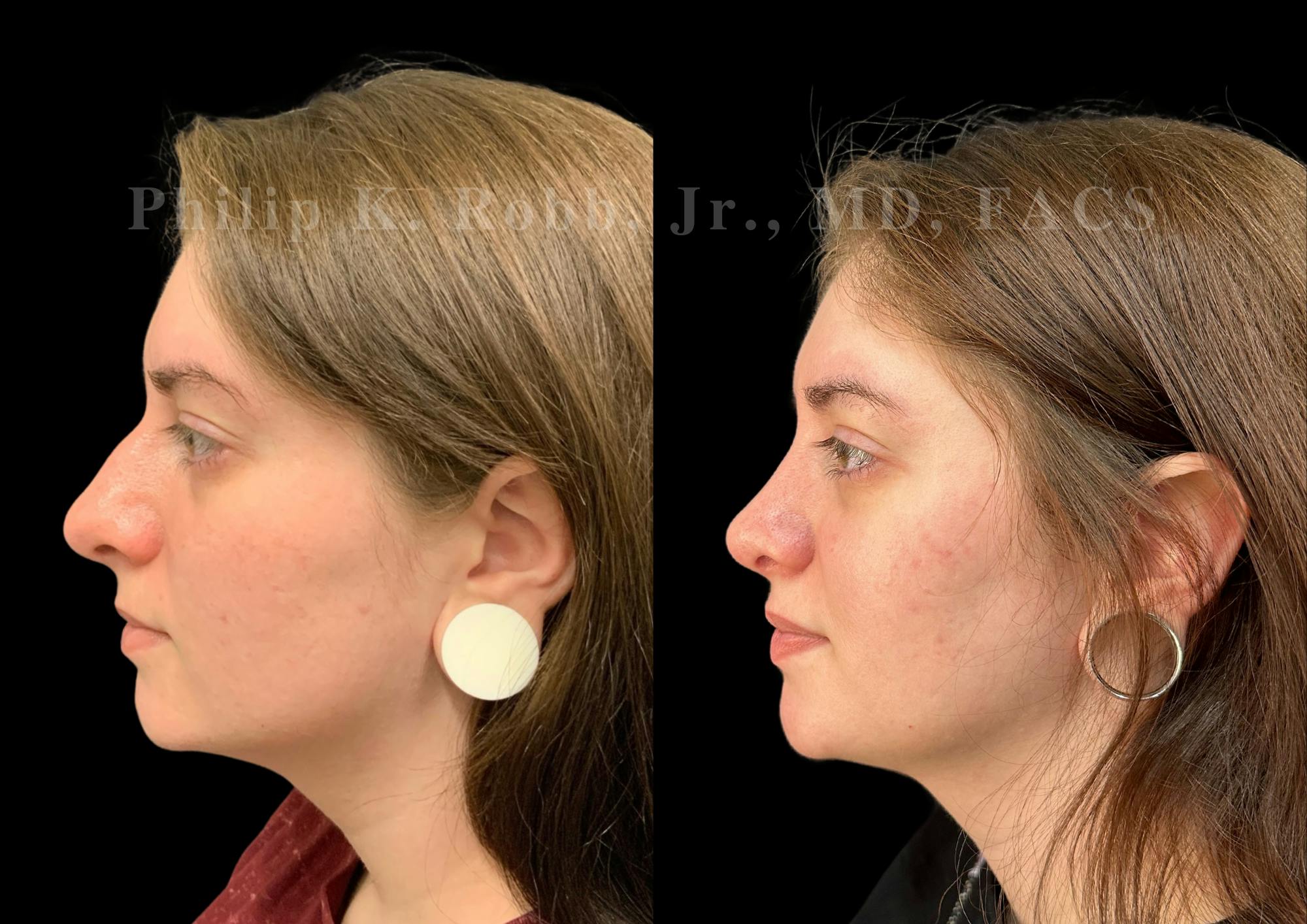 Ultrasonic Rhinoplasty Before & After Gallery - Patient 102521 - Image 5