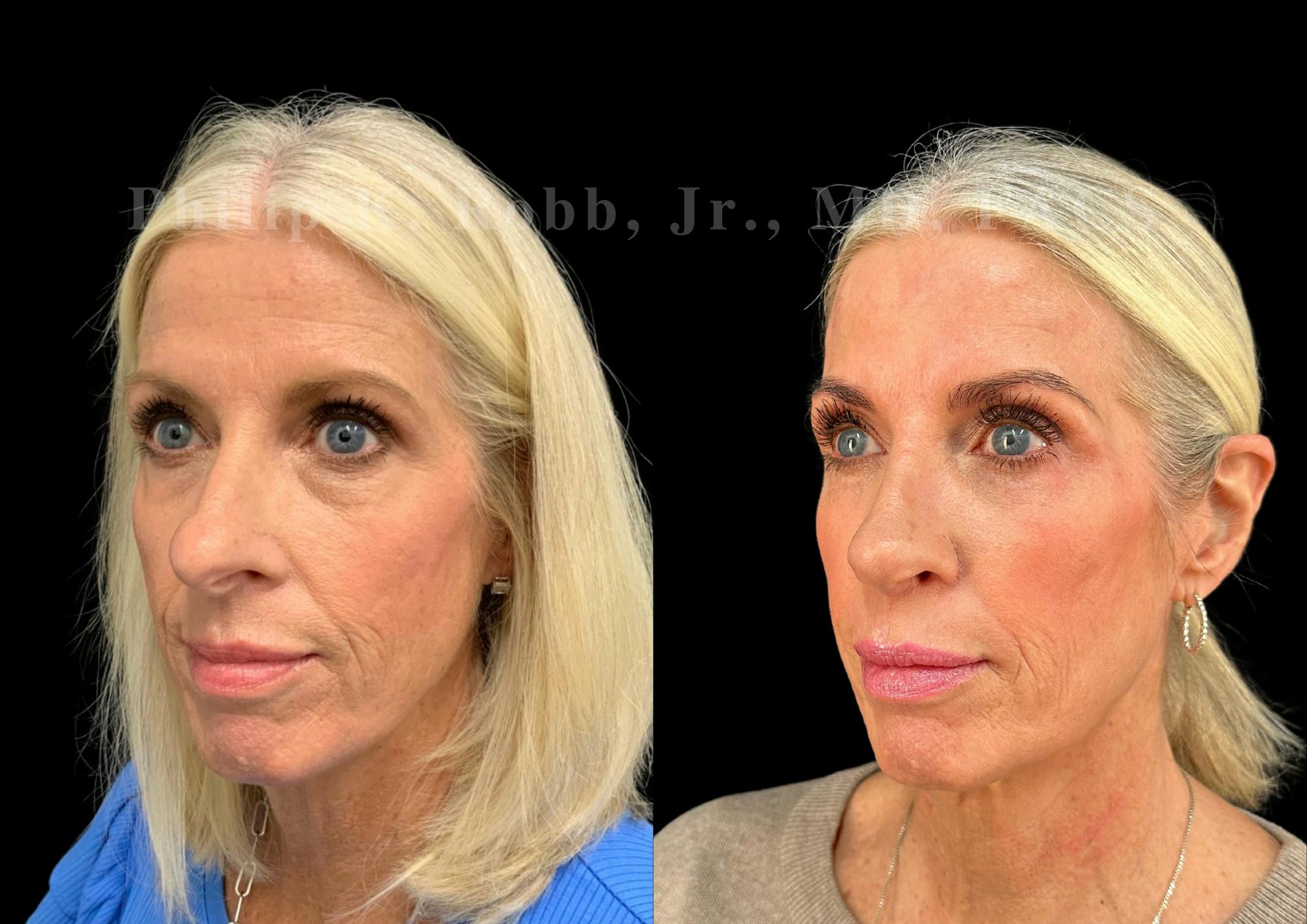 Ultrasonic Rhinoplasty Before & After Gallery - Patient 737576 - Image 4