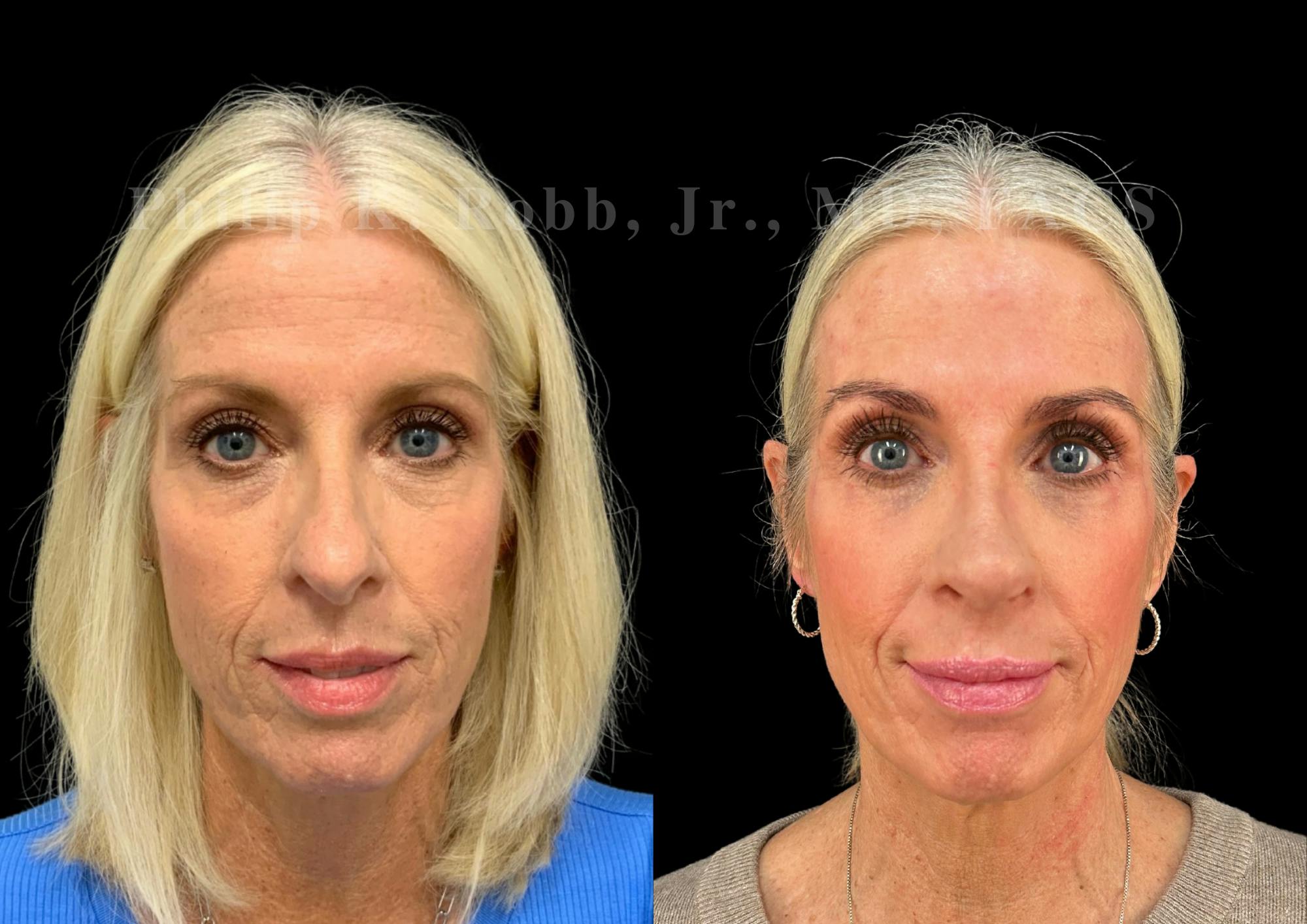 Ultrasonic Rhinoplasty Before & After Gallery - Patient 737576 - Image 3