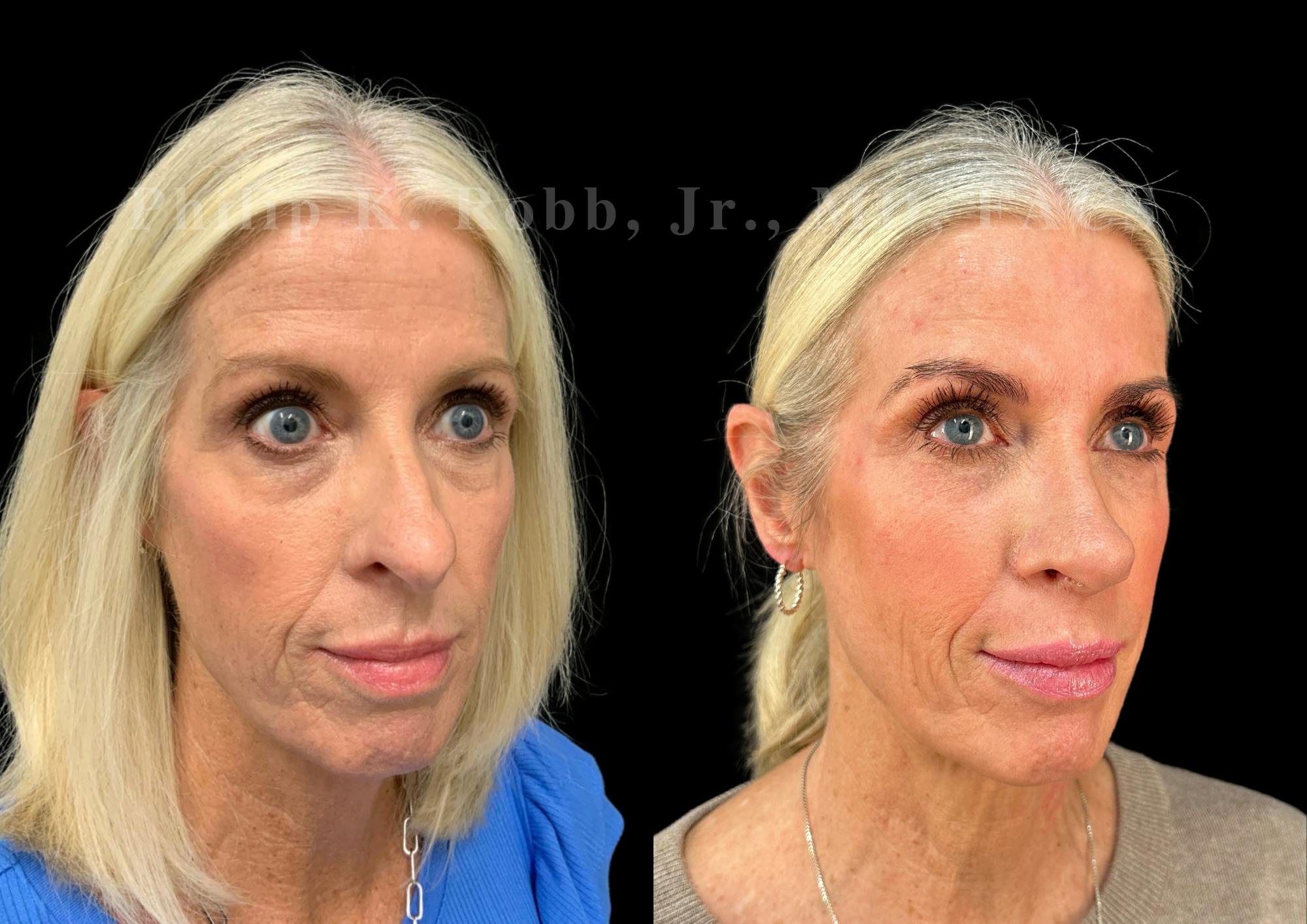 Ultrasonic Rhinoplasty Before & After Gallery - Patient 737576 - Image 2