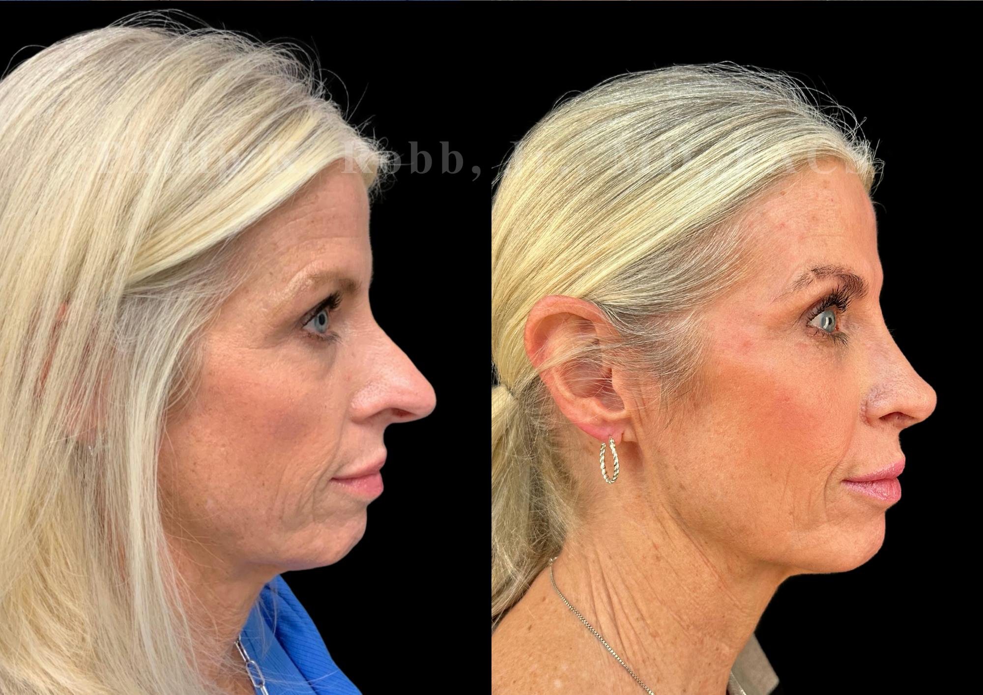 Ultrasonic Rhinoplasty Before & After Gallery - Patient 737576 - Image 1