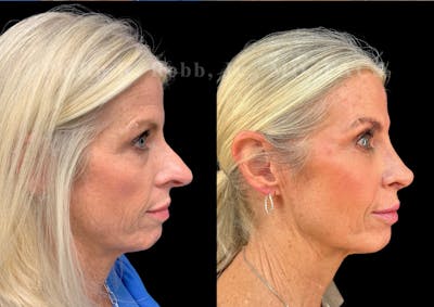 Ultrasonic Rhinoplasty Before & After Gallery - Patient 737576 - Image 1