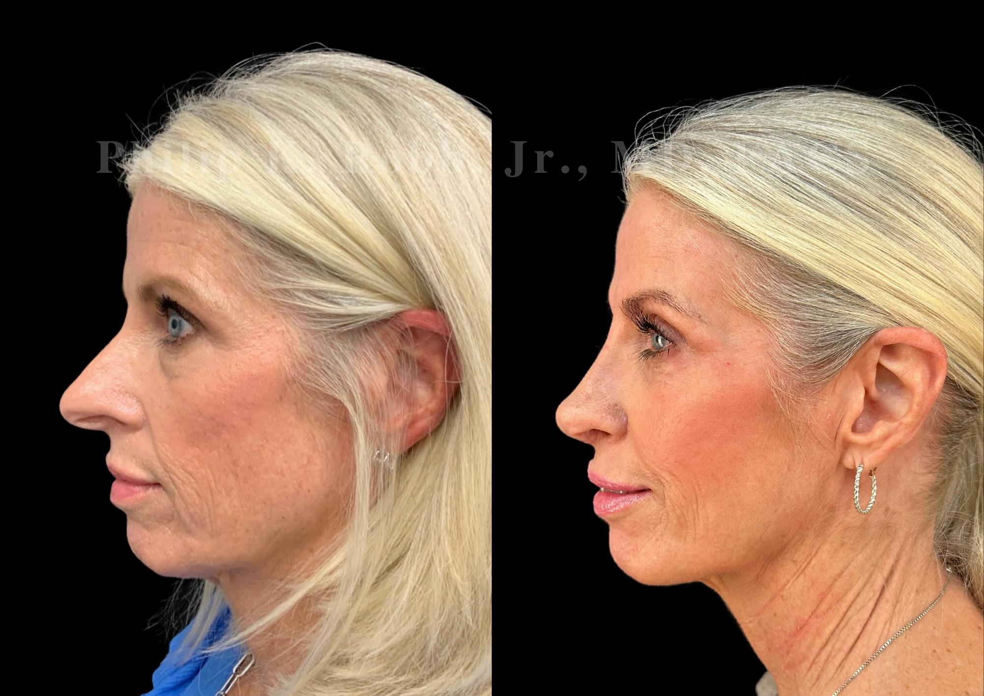 Ultrasonic Rhinoplasty Before & After Gallery - Patient 737576 - Image 5