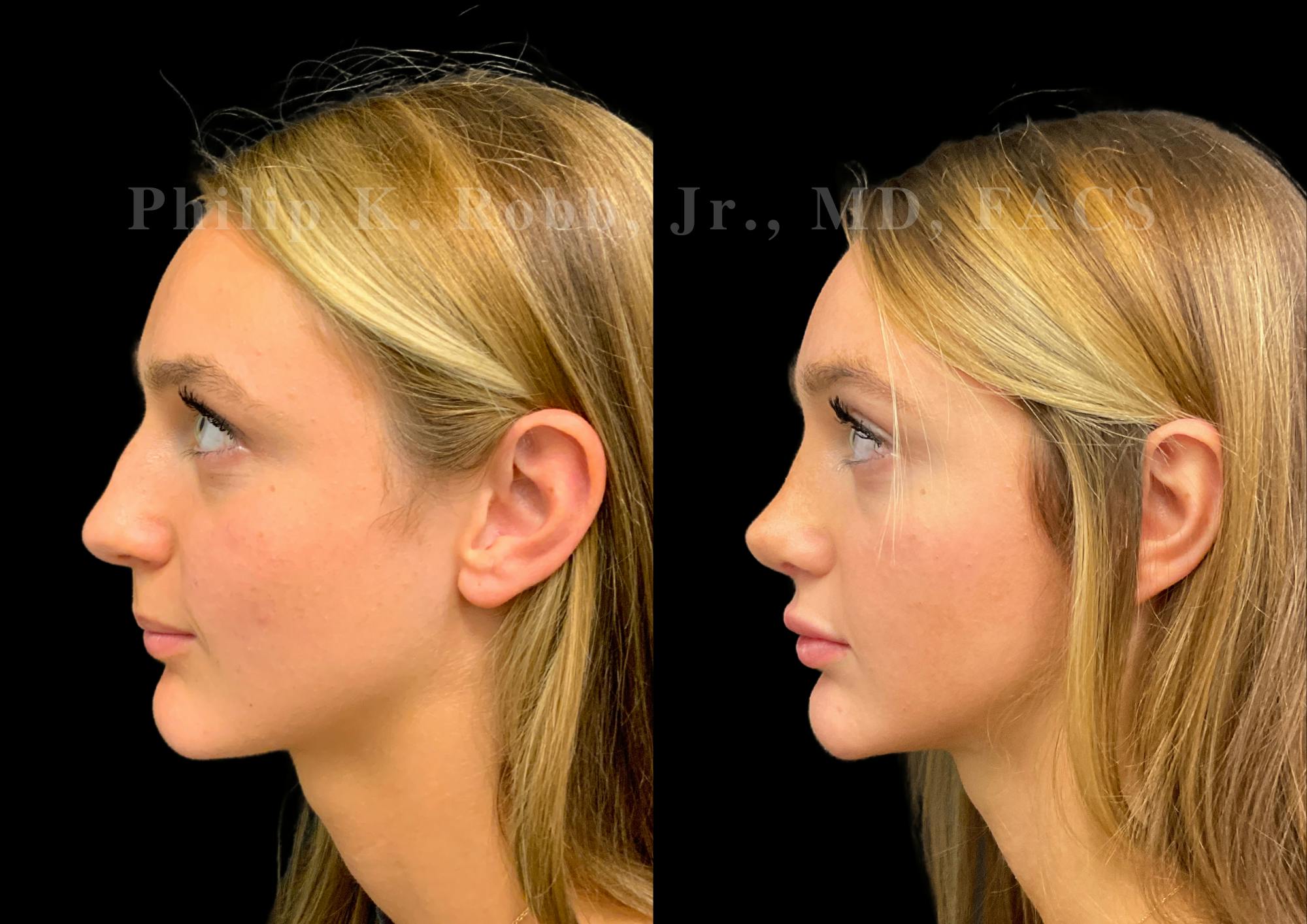 Ultrasonic Rhinoplasty Before & After Gallery - Patient 280983 - Image 5