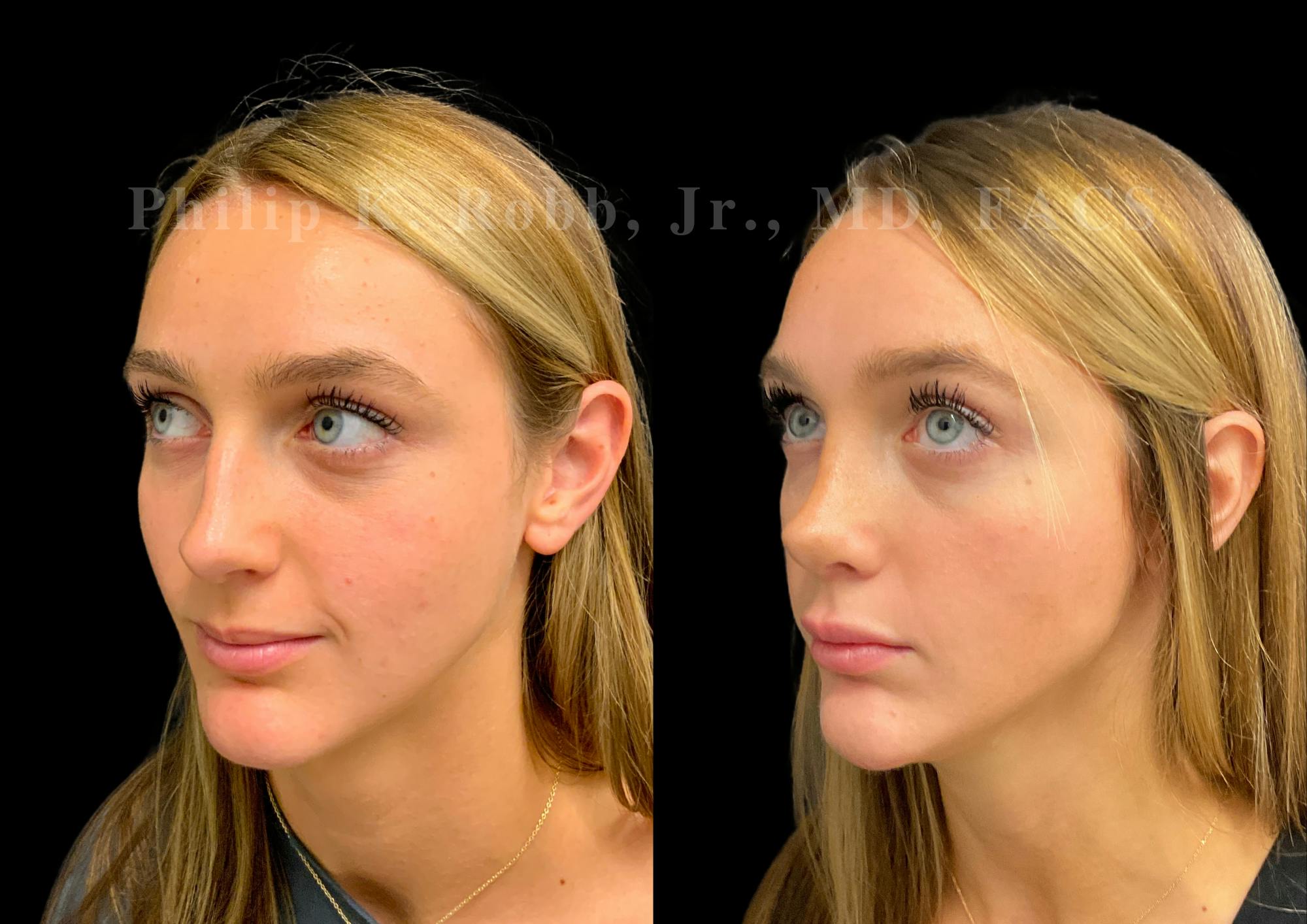 Ultrasonic Rhinoplasty Before & After Gallery - Patient 280983 - Image 4