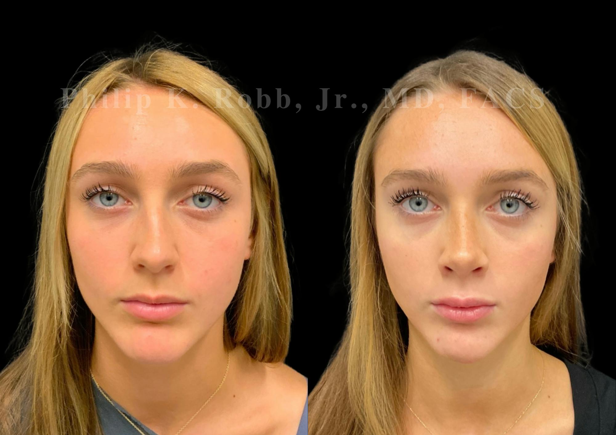 Ultrasonic Rhinoplasty Before & After Gallery - Patient 280983 - Image 3