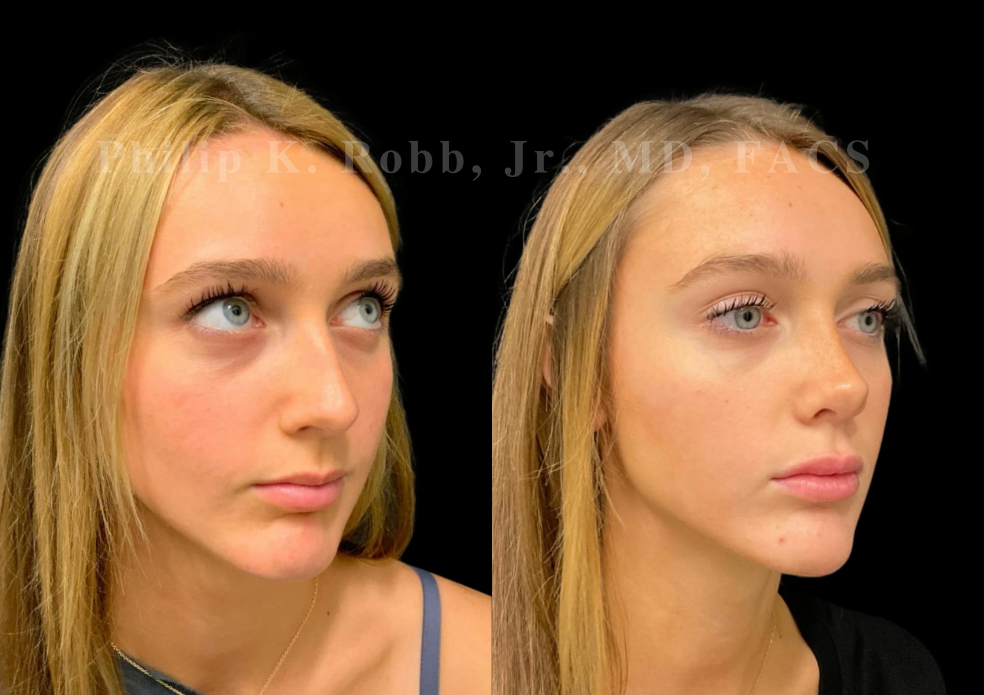Ultrasonic Rhinoplasty Before & After Gallery - Patient 280983 - Image 2