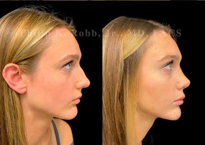 Ultrasonic Rhinoplasty Before & After Gallery - Patient 280983 - Image 1
