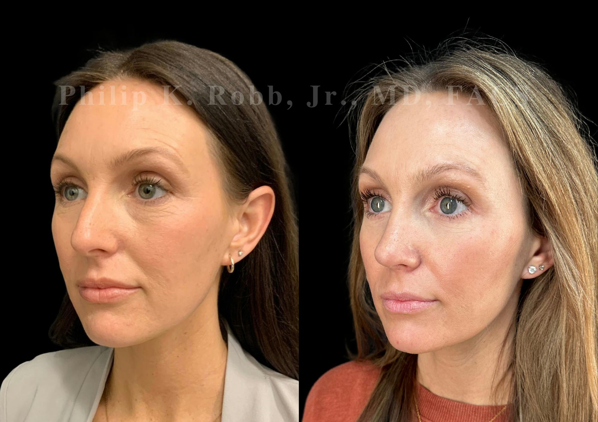Ultrasonic Rhinoplasty Before & After Gallery - Patient 207861 - Image 4