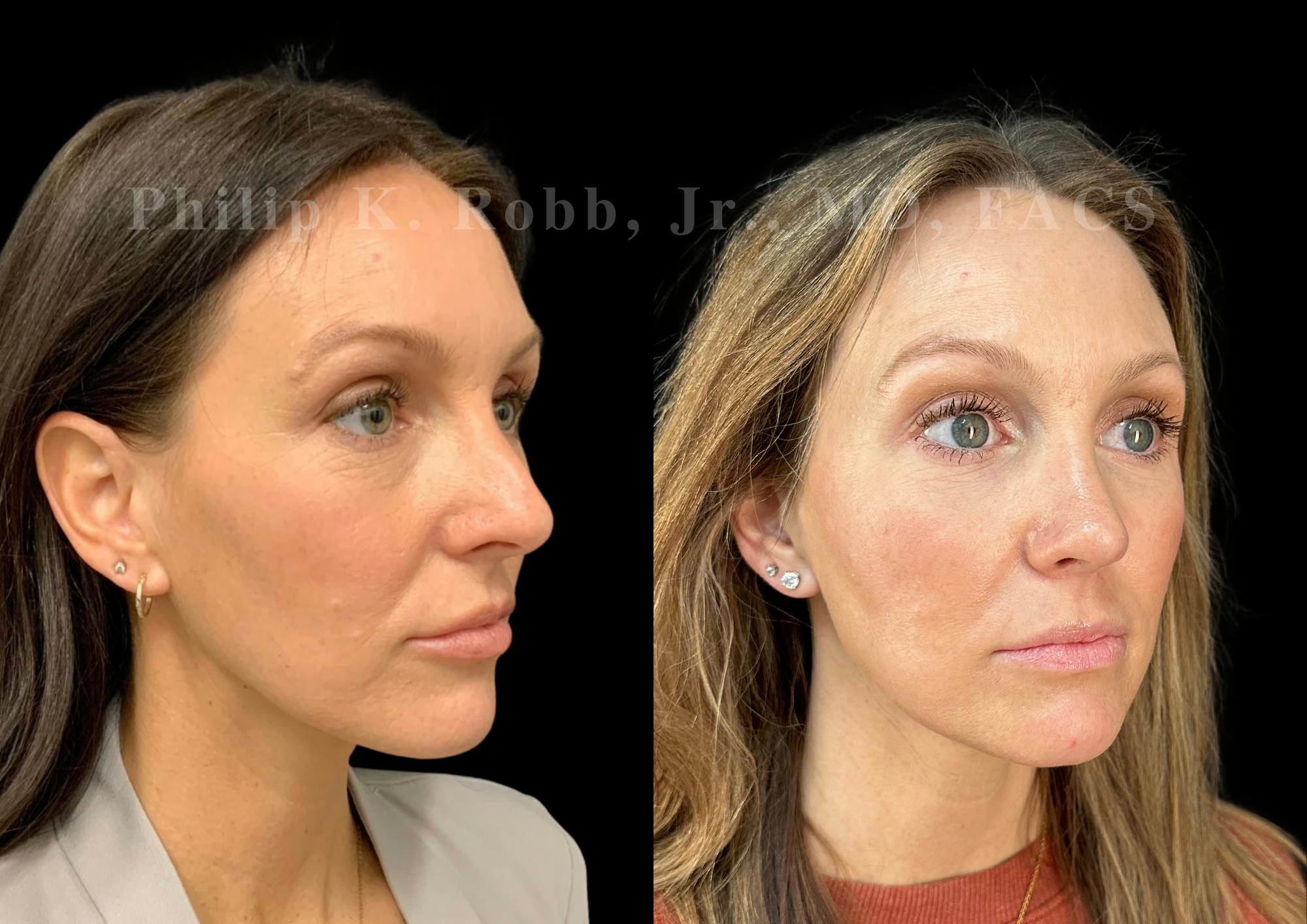 Ultrasonic Rhinoplasty Before & After Gallery - Patient 207861 - Image 2