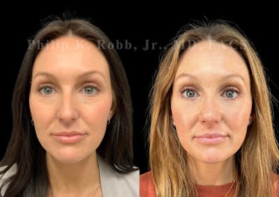 Laser Skin Resurfacing Before & After Gallery - Patient 152998 - Image 1