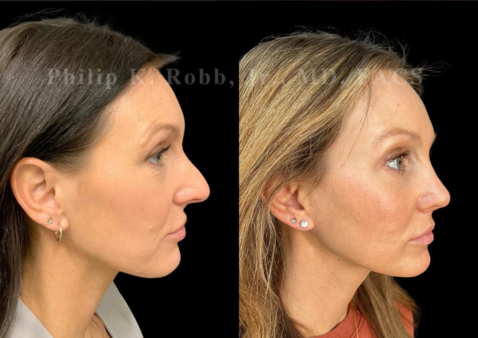 Ultrasonic Rhinoplasty Before & After Gallery - Patient 207861 - Image 1