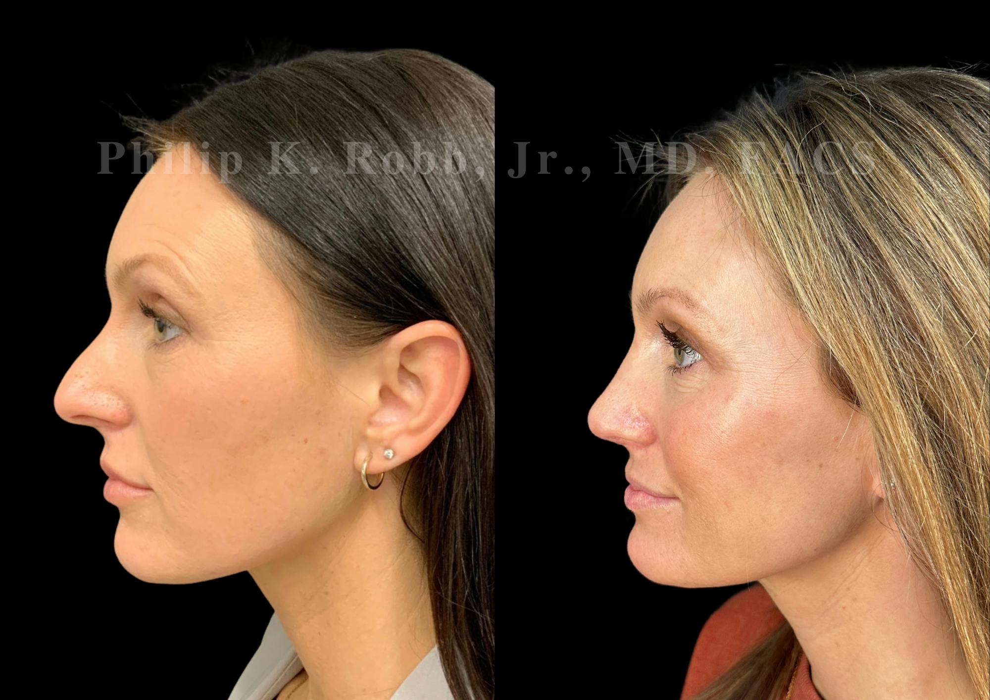 Ultrasonic Rhinoplasty Before & After Gallery - Patient 207861 - Image 5
