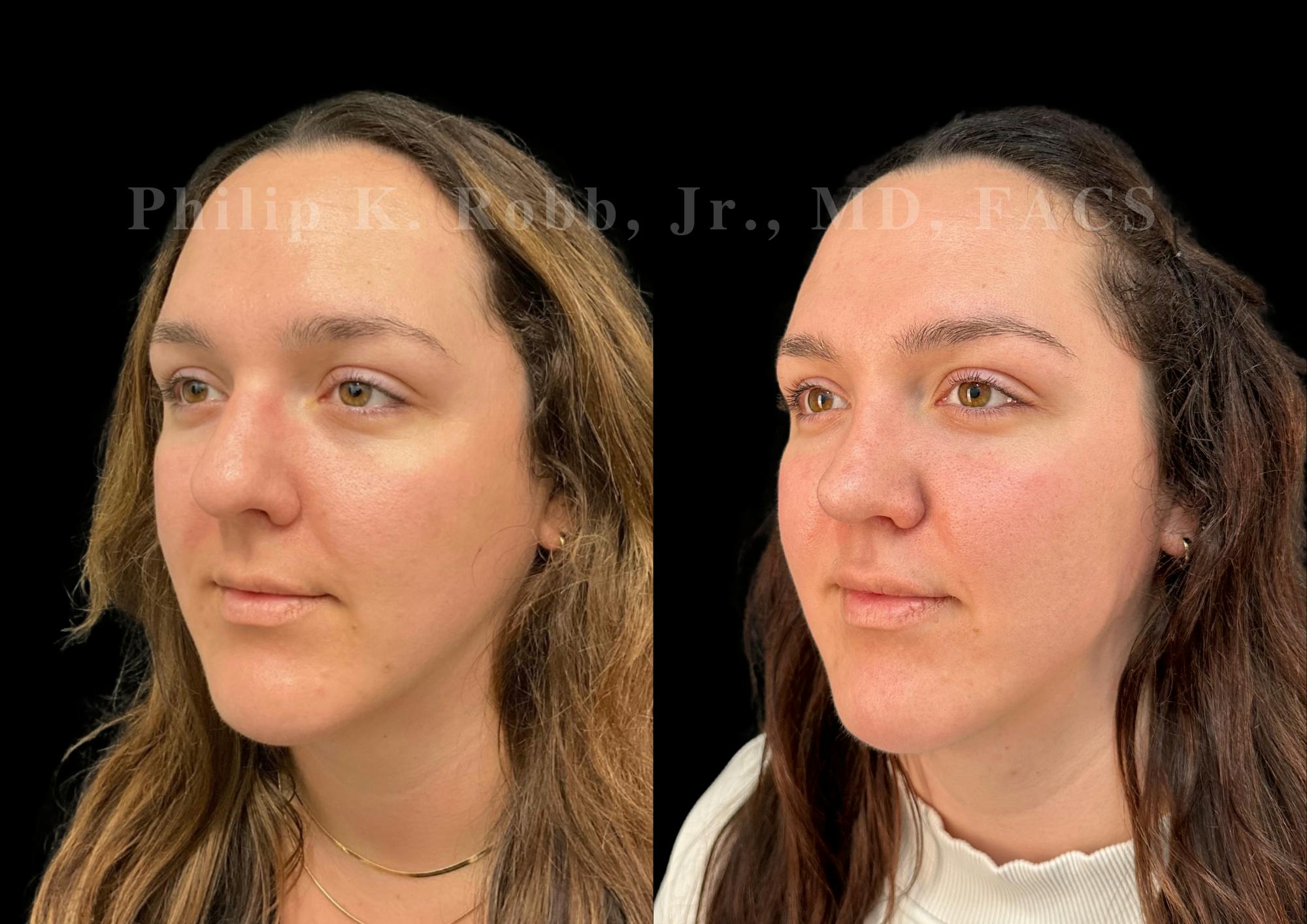 Ultrasonic Rhinoplasty Before & After Gallery - Patient 250099 - Image 4