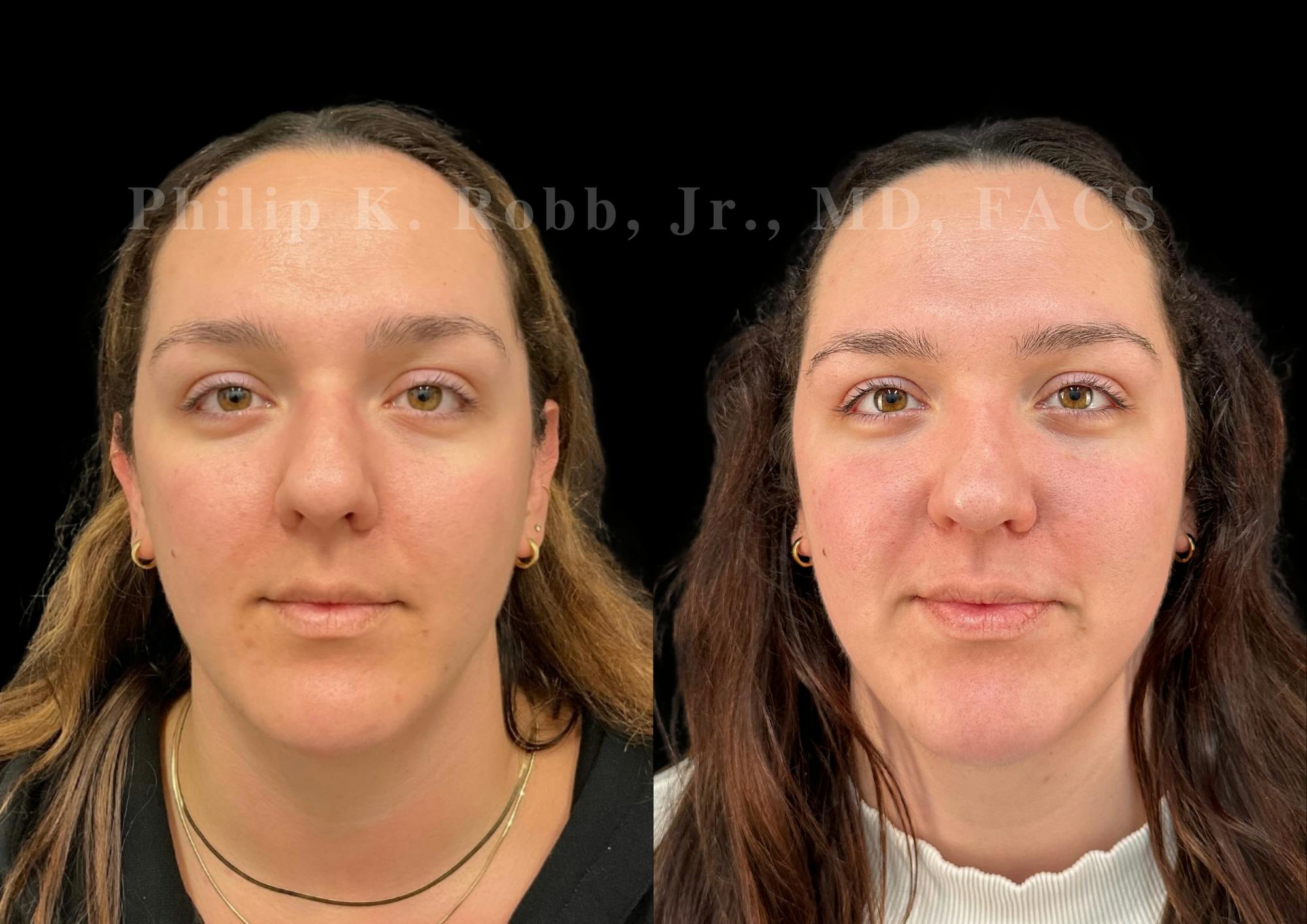 Ultrasonic Rhinoplasty Before & After Gallery - Patient 250099 - Image 3