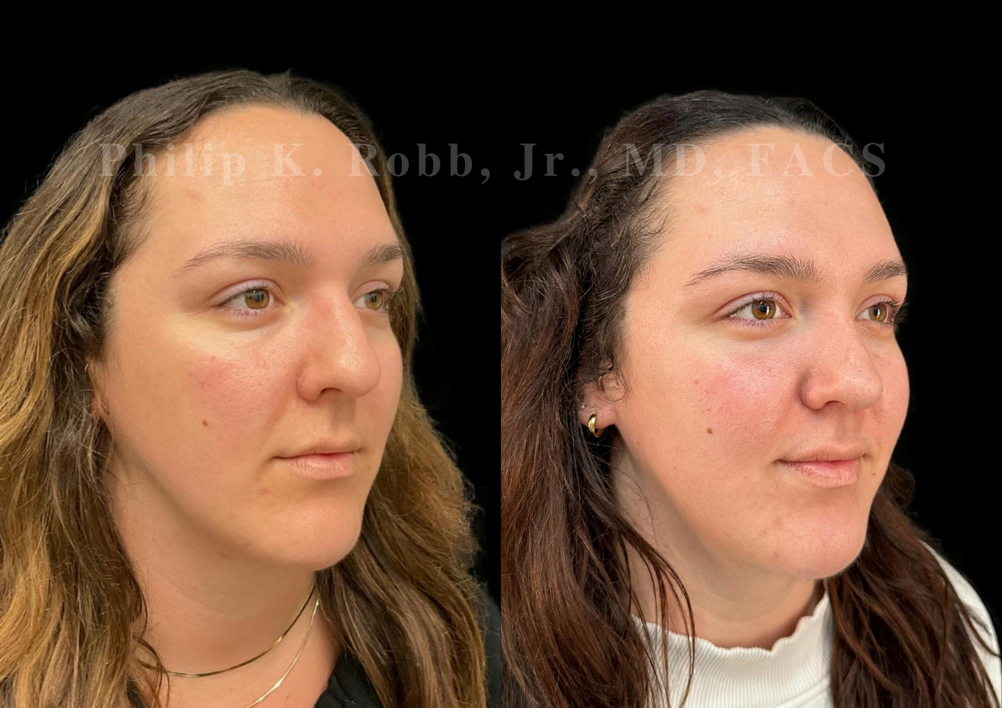 Ultrasonic Rhinoplasty Before & After Gallery - Patient 250099 - Image 2