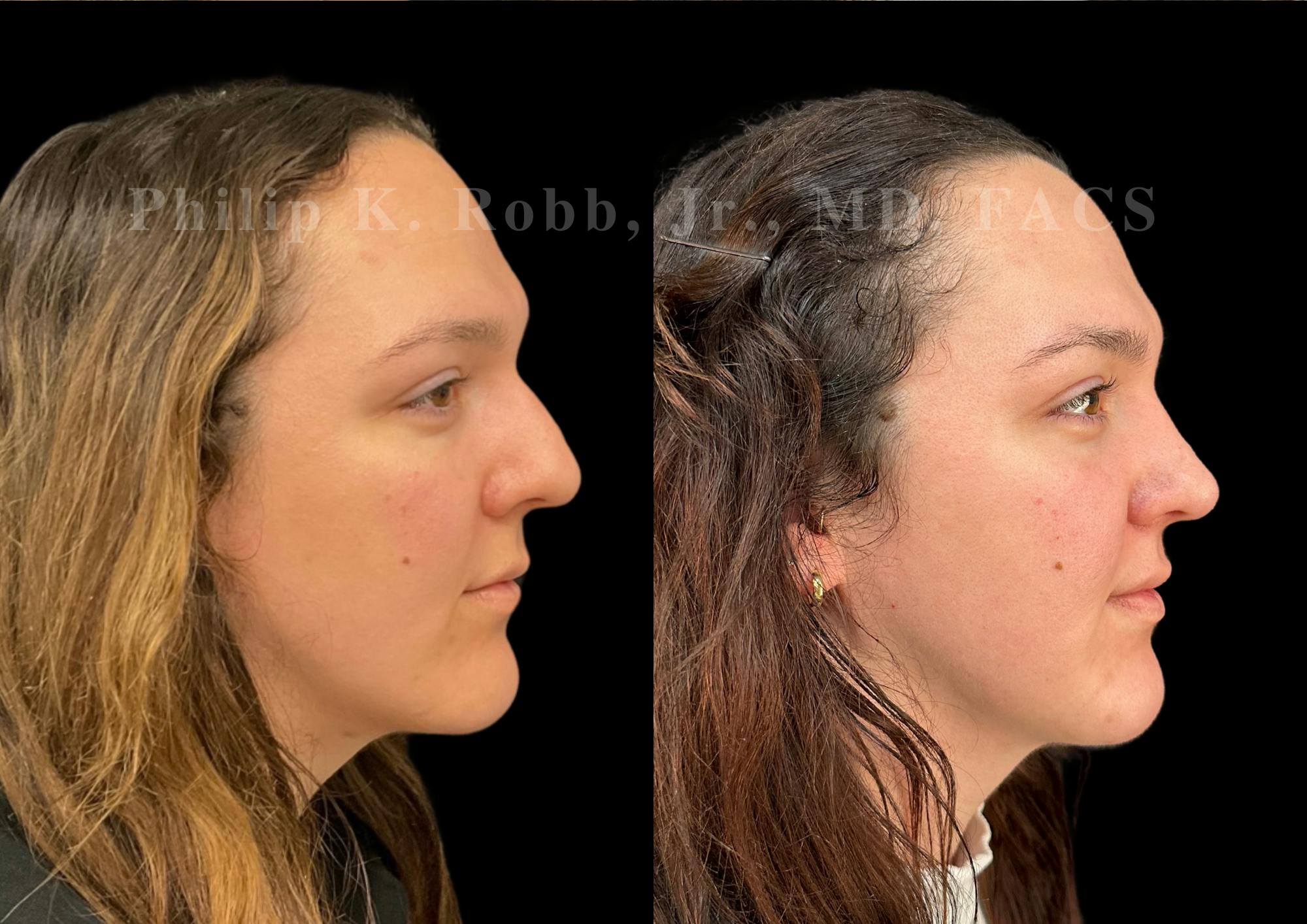 Ultrasonic Rhinoplasty Before & After Gallery - Patient 250099 - Image 1