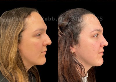 Ultrasonic Rhinoplasty Before & After Gallery - Patient 250099 - Image 1